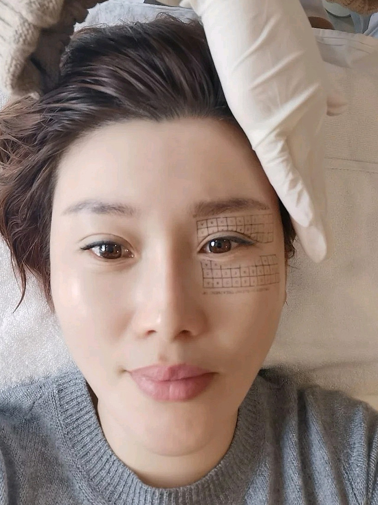 首次操作眼部,上眼皮提升效果立竿见影,好后悔没有早_圈子-新氧美容