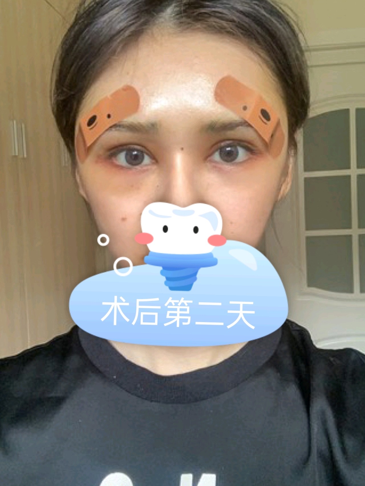 眉弓手术第二天肿成熊猫眼了