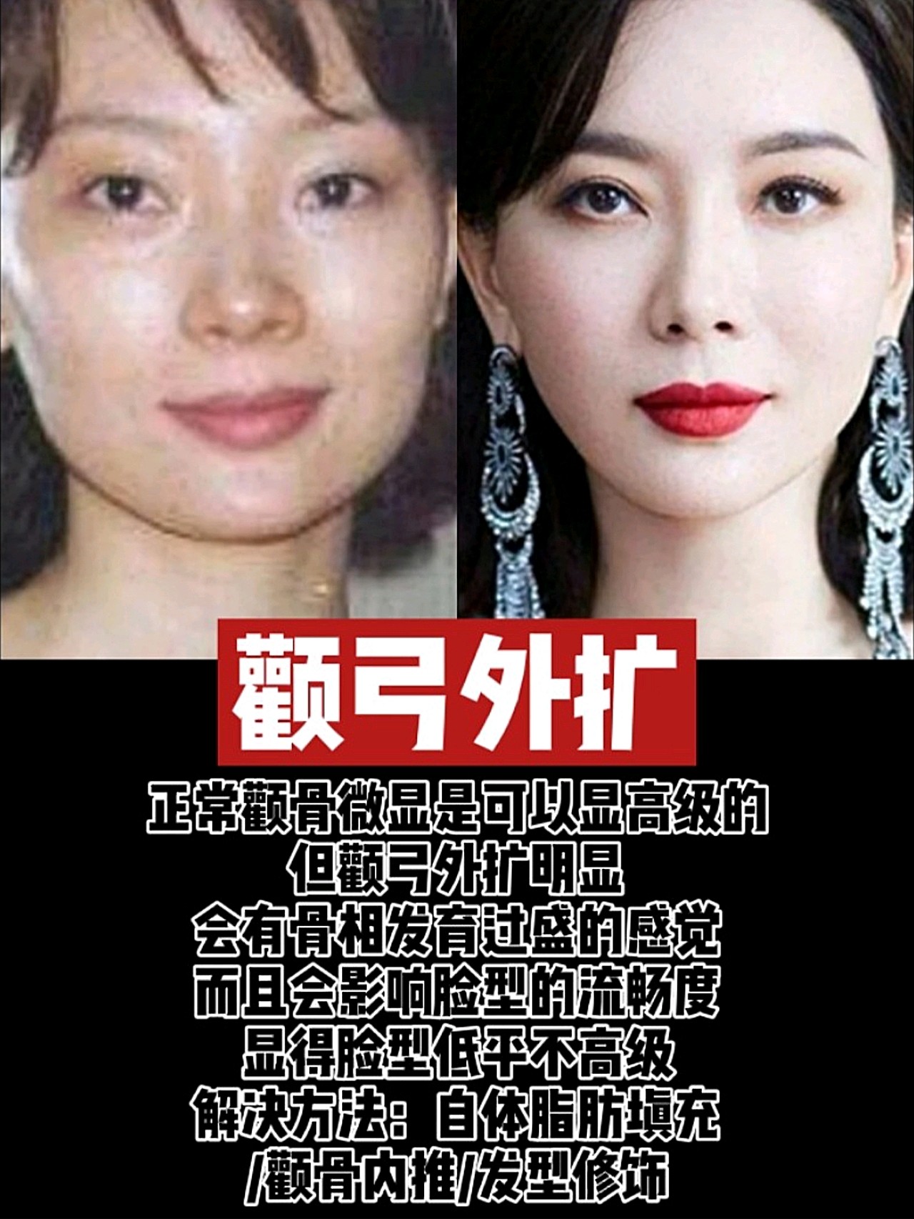 ①颧弓外扩正常颧骨微显是可以显高_圈子-新氧美容整形