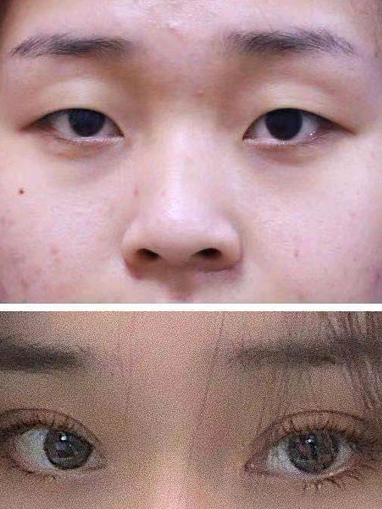 双眼皮术后一个月终于告别小眼睛了