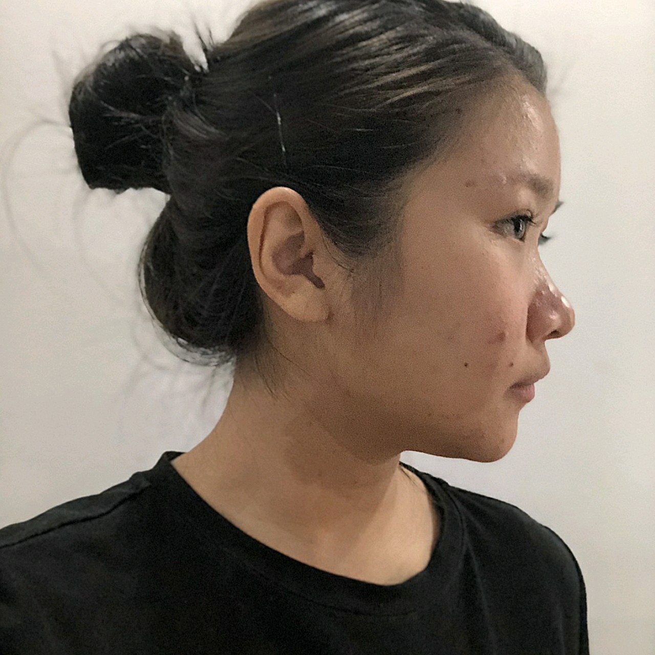 黑龙江瑞丽假体隆鼻耳软骨垫鼻尖