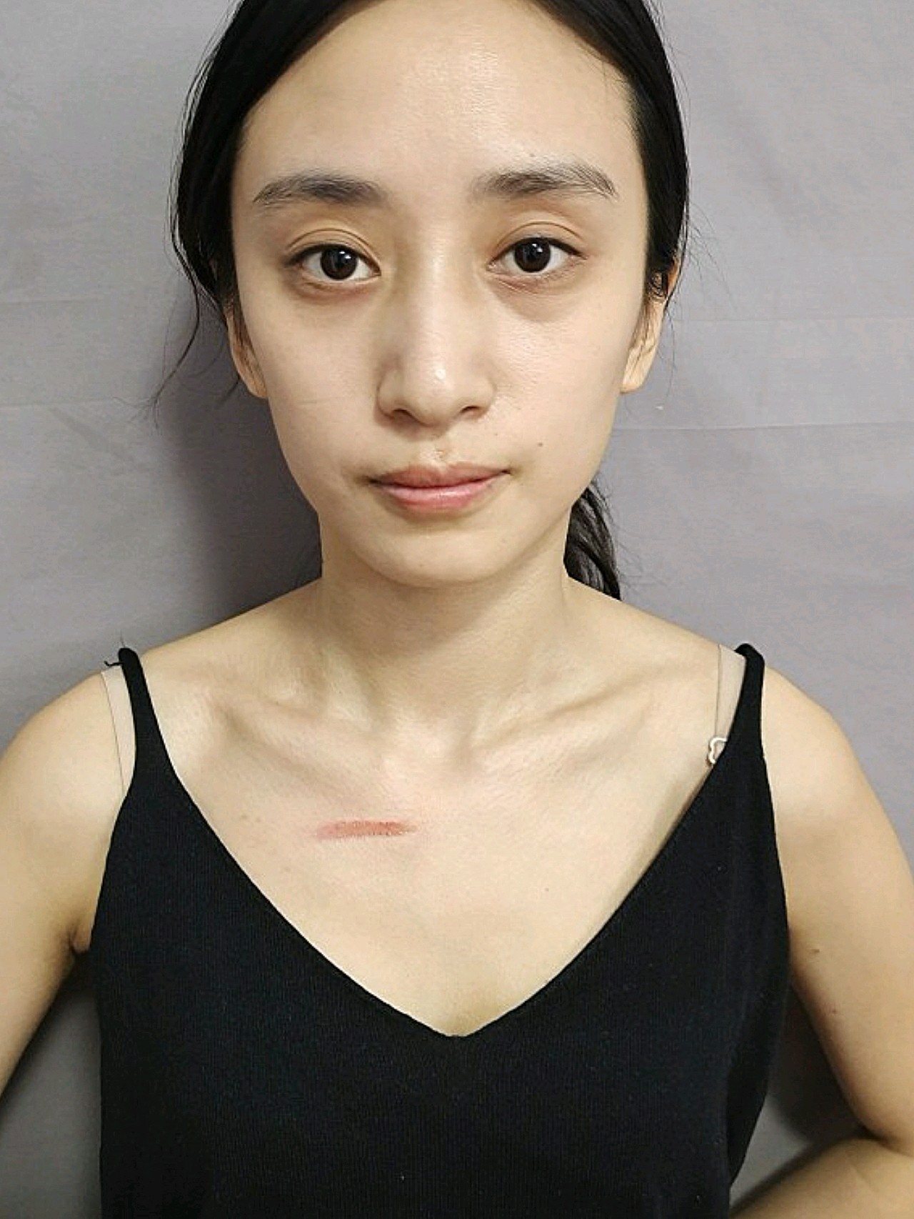 发现做了离子束祛疤治疗后疤痕确实有了好转,前两天结_圈子-新氧美容