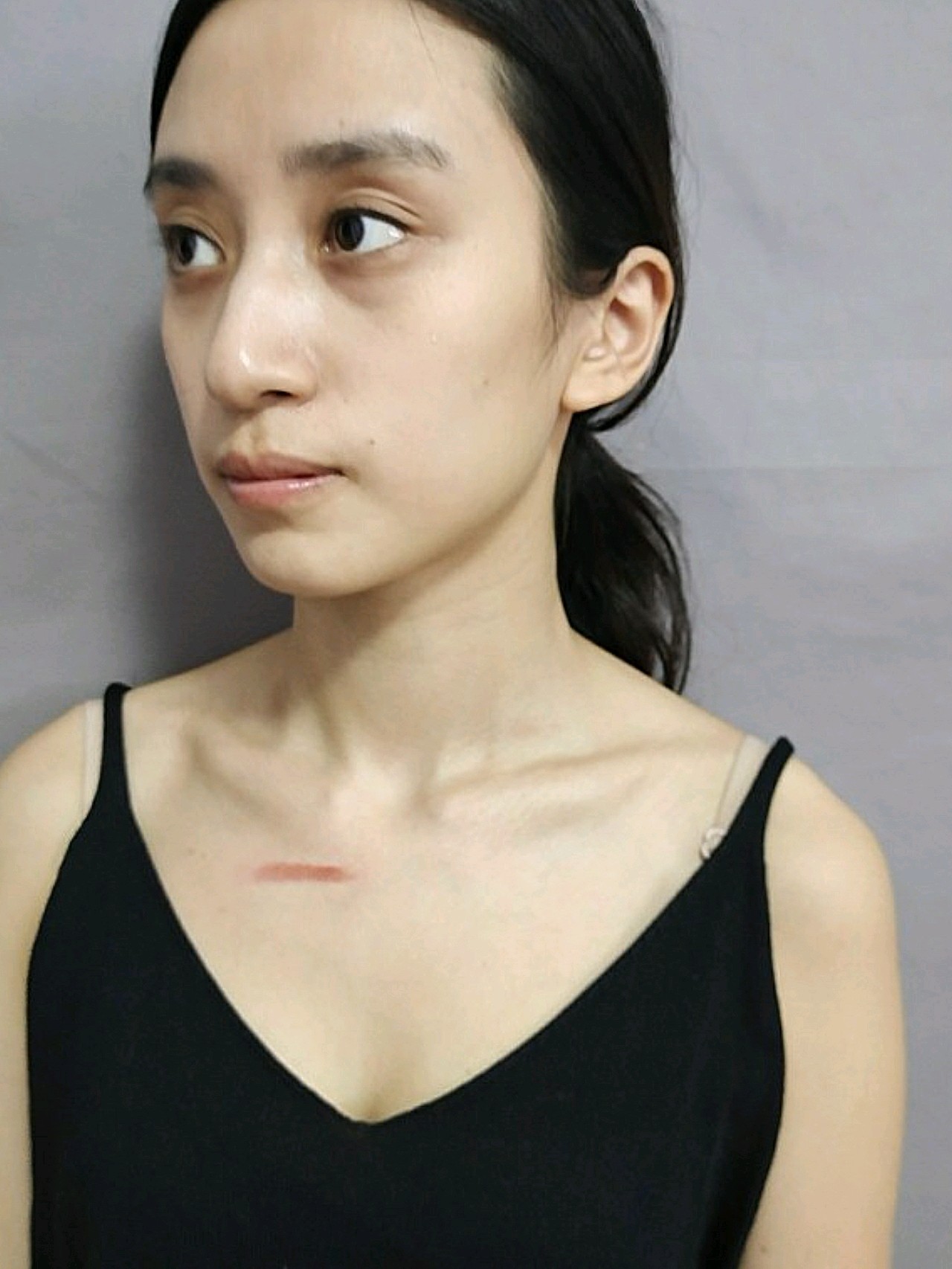 发现做了离子束祛疤治疗后疤痕确实有了好转,前两天结_圈子-新氧美容