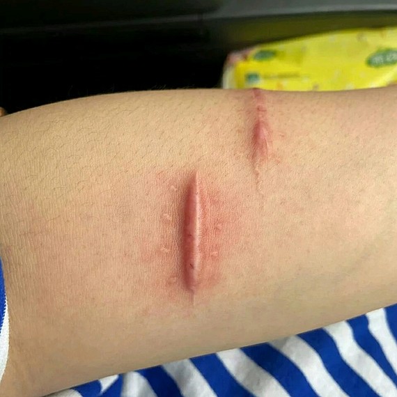 之前就是骑车的时候手臂摔了就留下了伤疤,疤痕特别的