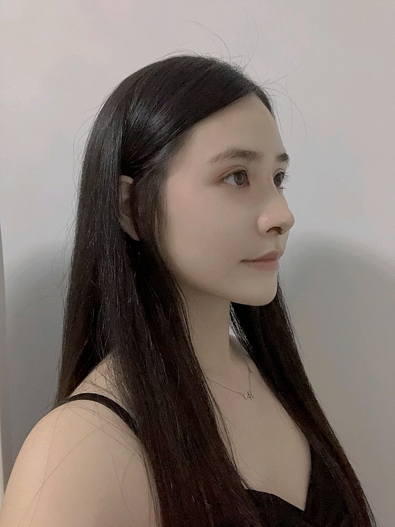 在南宁奢梵做完膨体隆鼻的第10天的照片