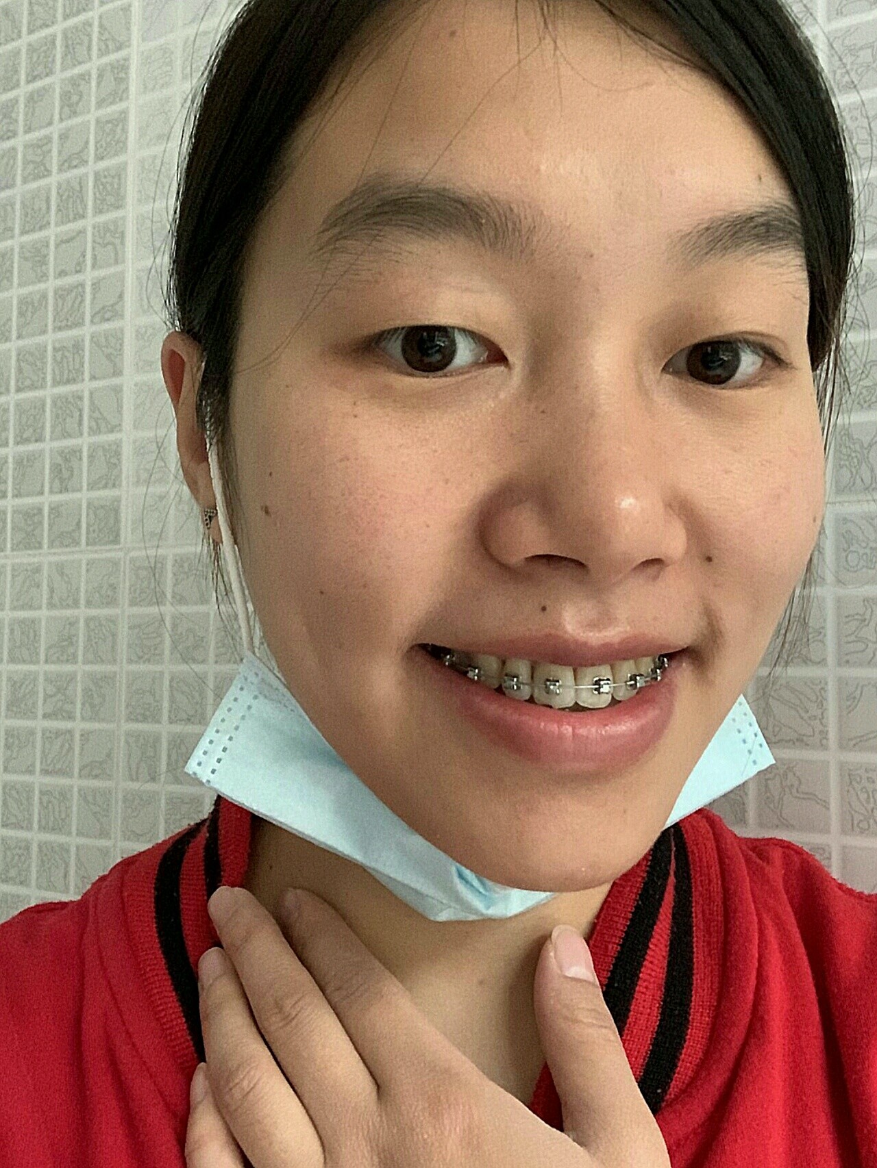 这个月依然还处于牙齿矫正的排齐阶段,现在上排牙可以_圈子-新氧美容