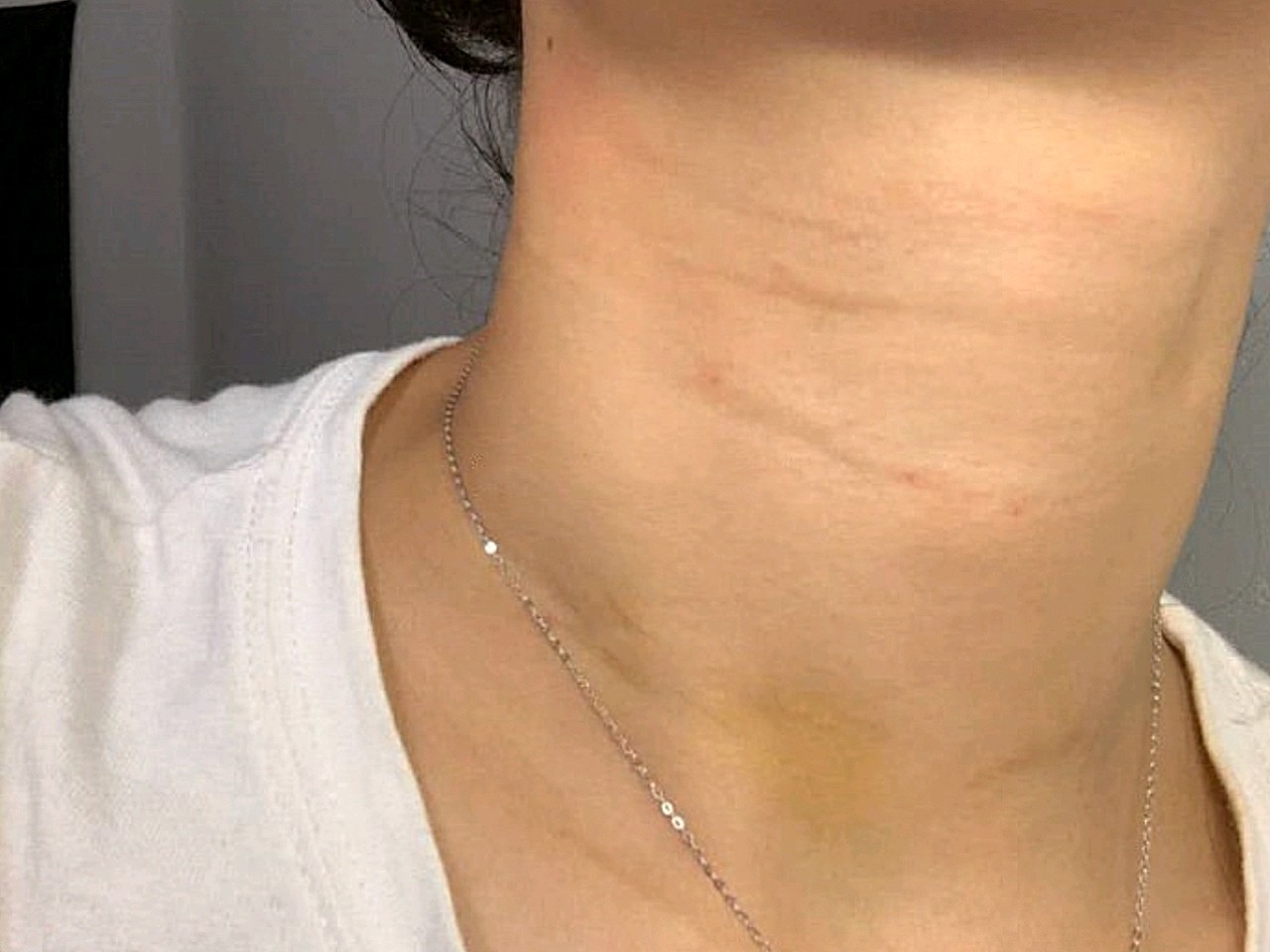 现在脖子看起来像一个刚从勒紧的麻绳里逃生的人.