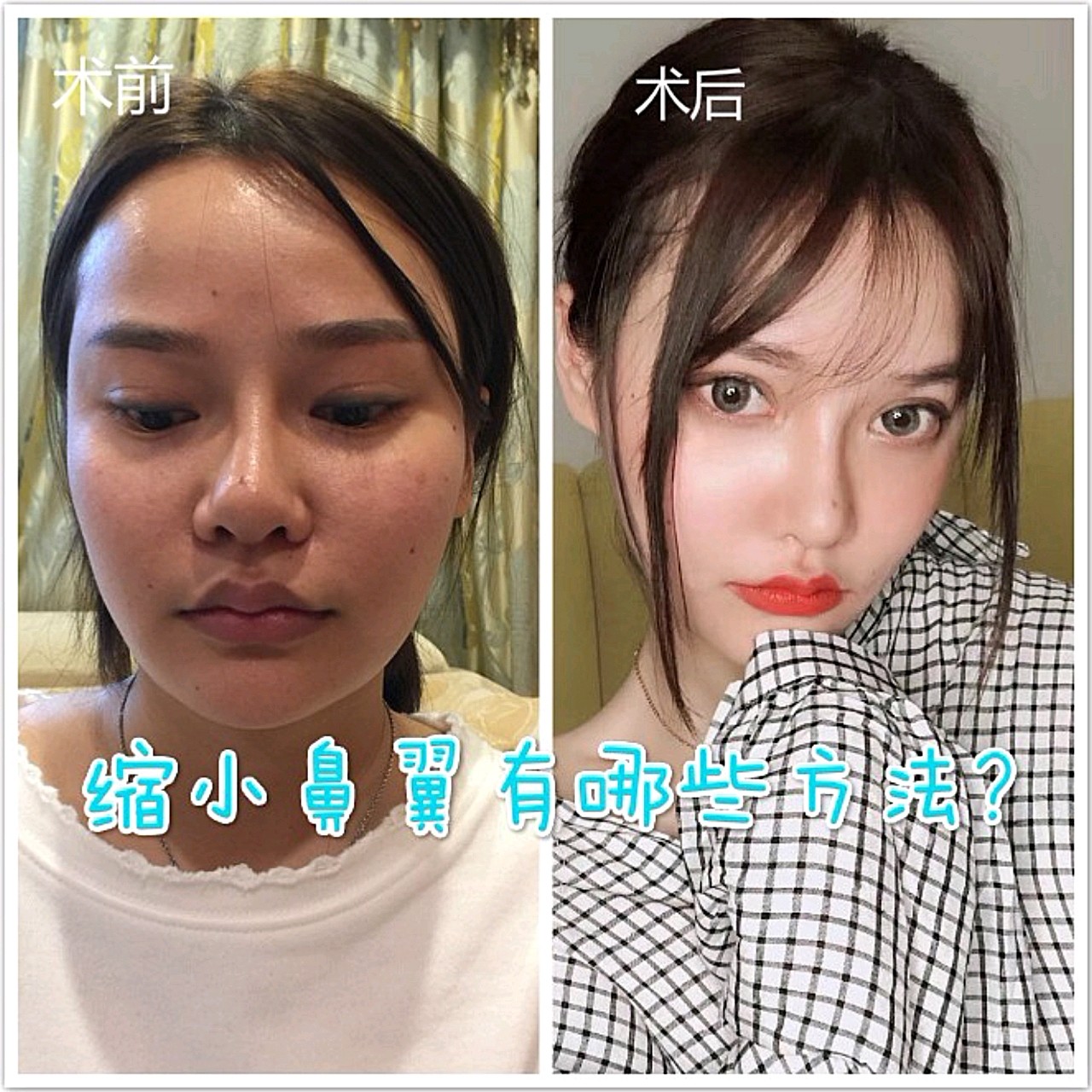 内切:留疤几率相对较小采用内切法做的鼻翼缩小手术,在外表看是没有