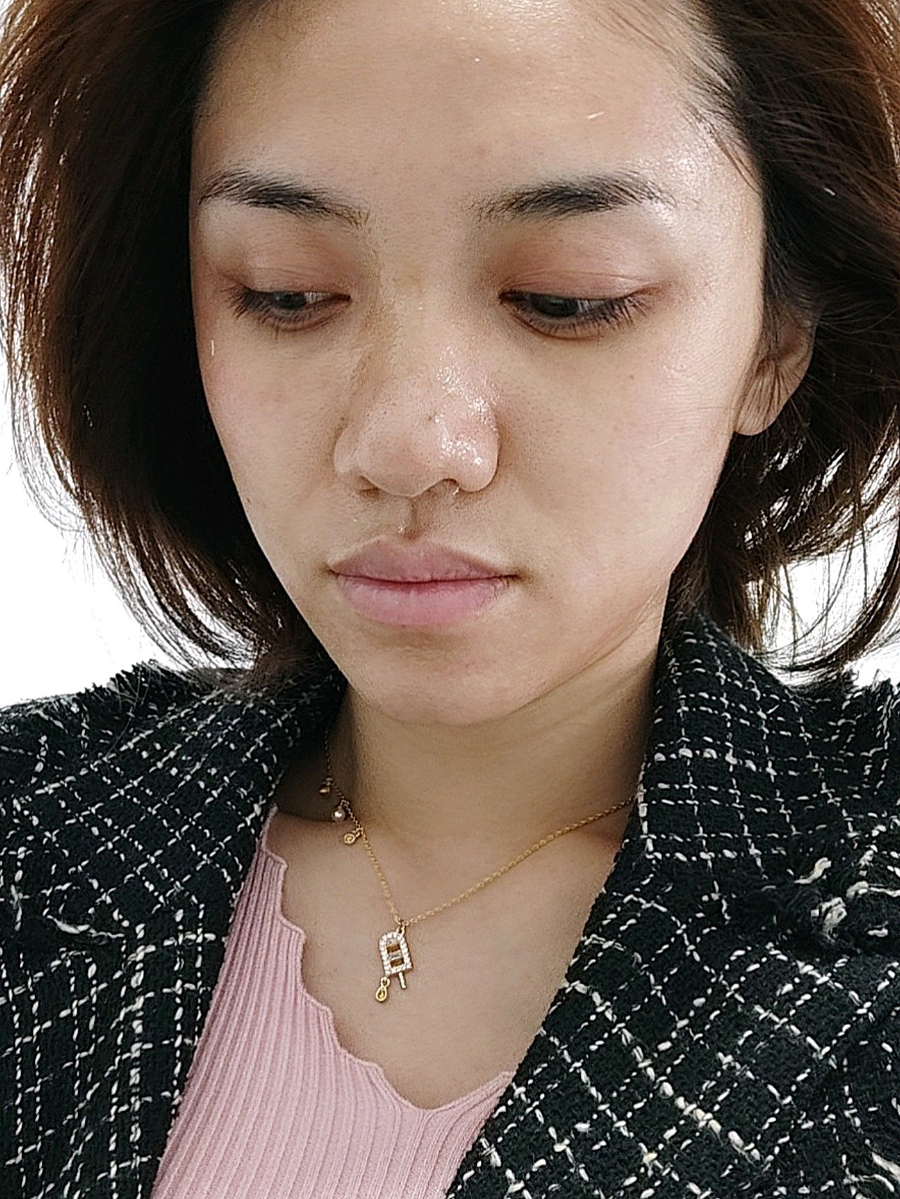 有点疼,医生打光很仔细,感觉皮肤有稍微细一点,前两_圈子-新氧美容