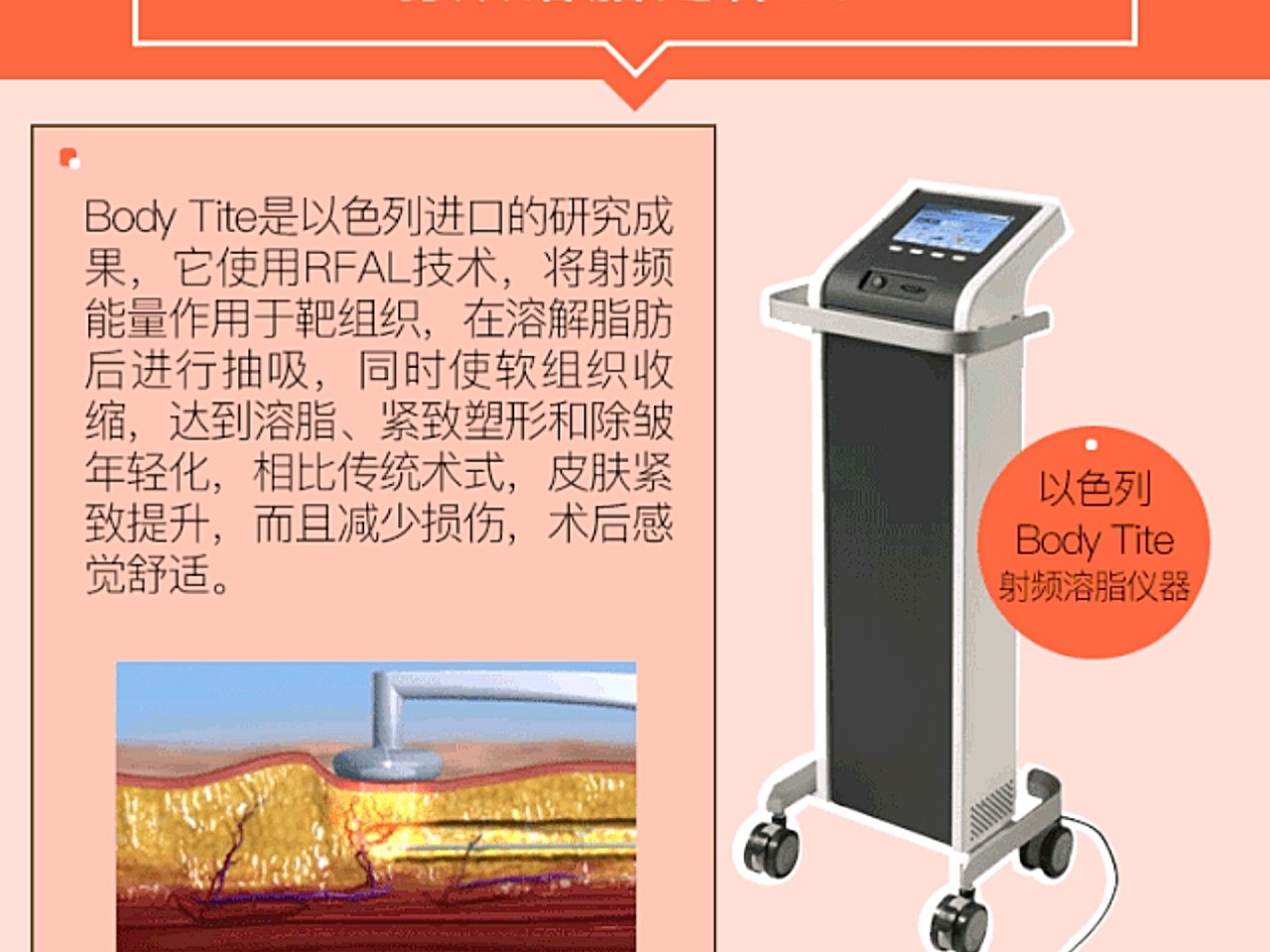 射频溶脂(宝丽太bodytite)