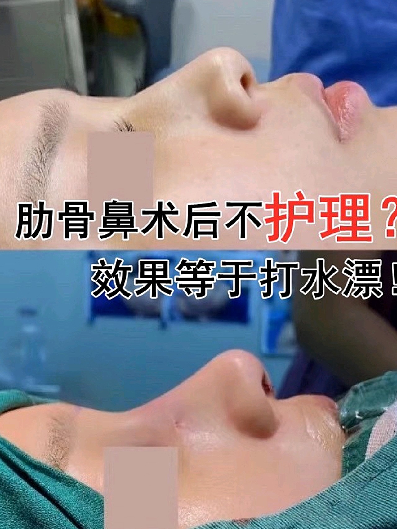 今天给大家分享一下肋骨鼻术后如何护理,想做鼻子的集美可以参考一