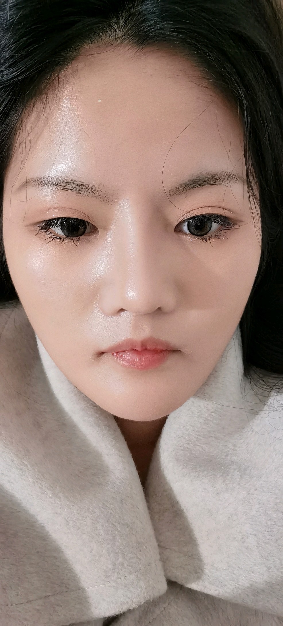 嘴唇薄,嘴角下垂打玻尿酸还是做手术?