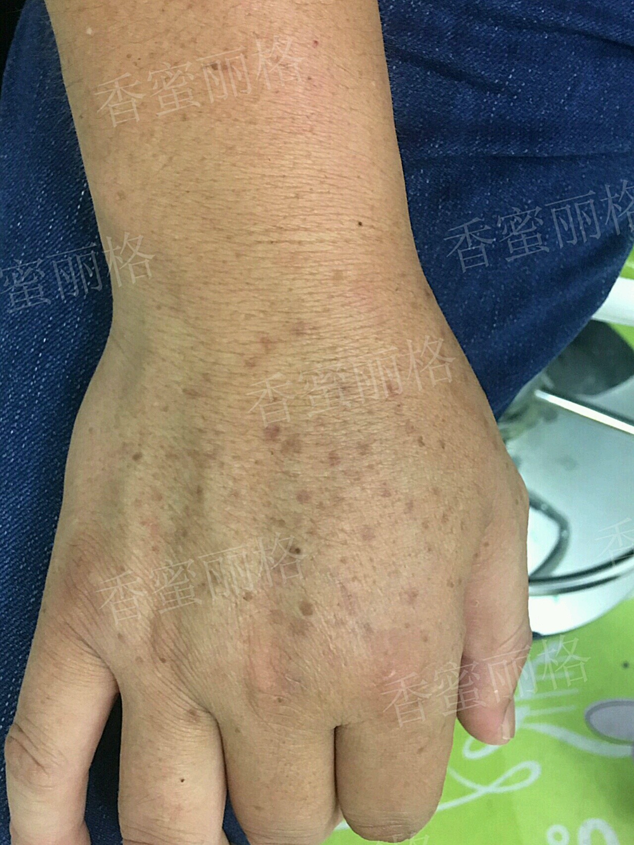 这次在香蜜丽格做的雷霆大q手部祛斑效果真的惊艳到