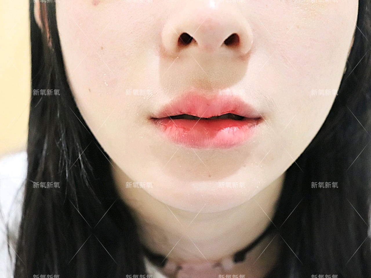 我的嘴唇比较平又薄,没有什么立体感,丰唇后看着饱满_圈子-新氧美容