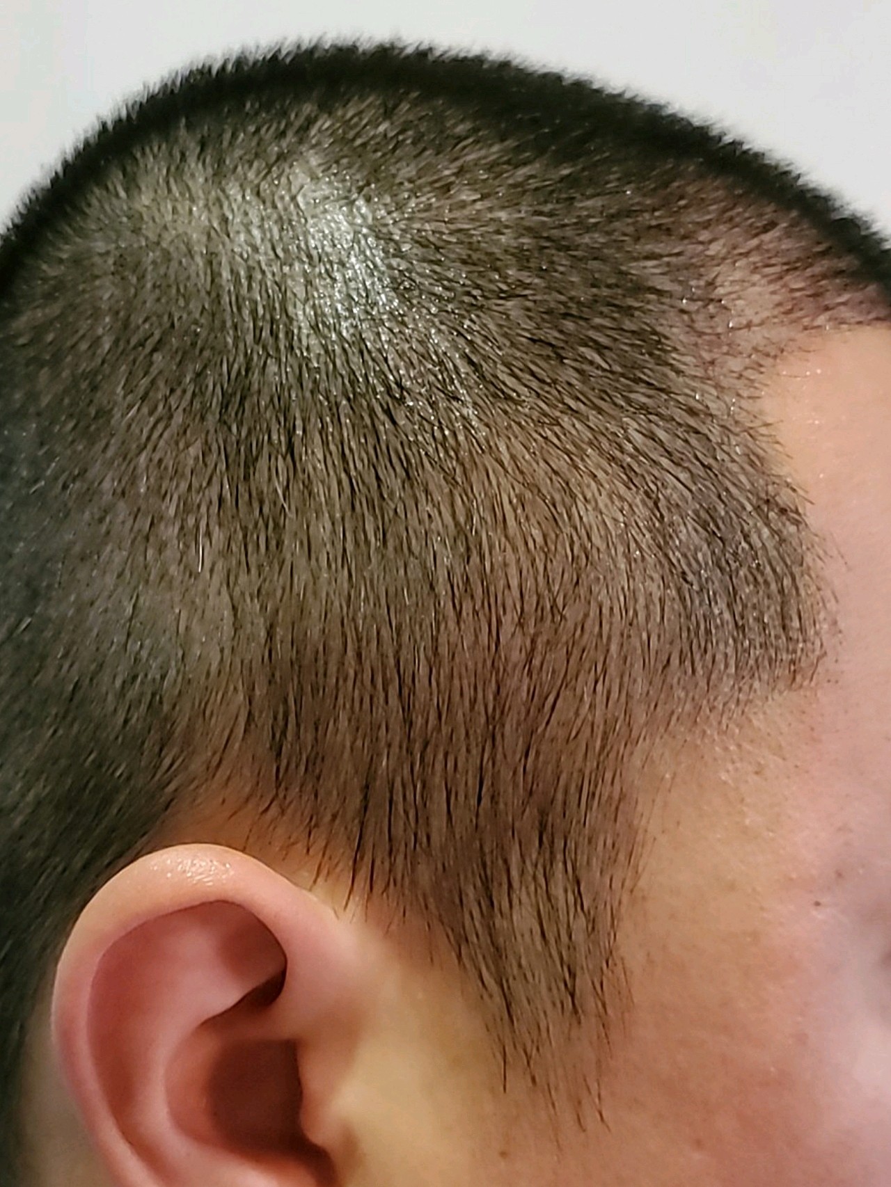 发旋植发脱落期(植发后发旋位置还是稀薄)