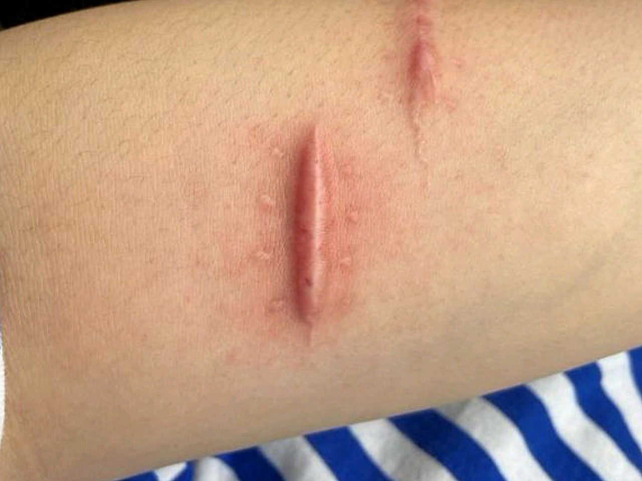 小时候调皮,把手臂摔了两条口子,当时在村里,诊所处_圈子-新氧美容