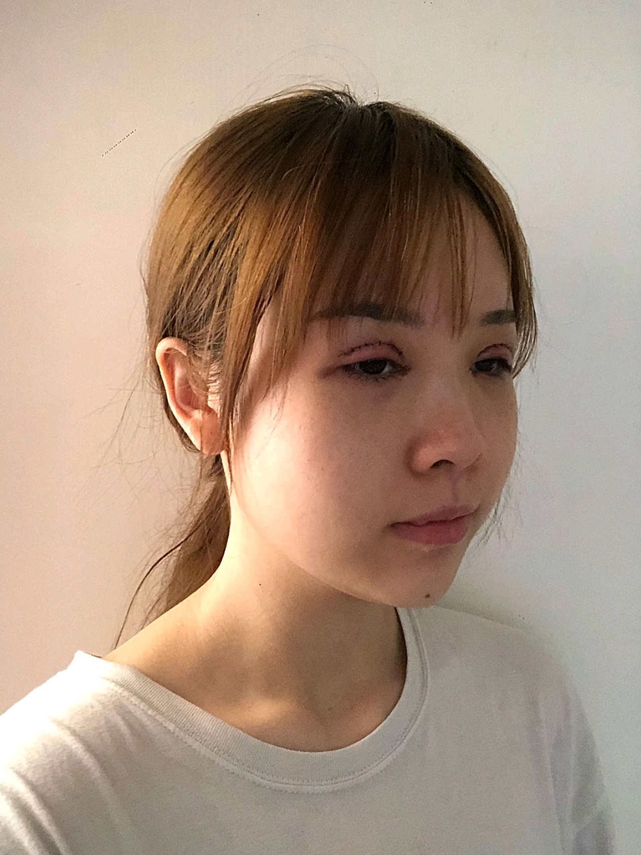 【双眼皮术后第3天】眼睛一如既往的红肿,肿胀的像个猪头,眼睛都有点