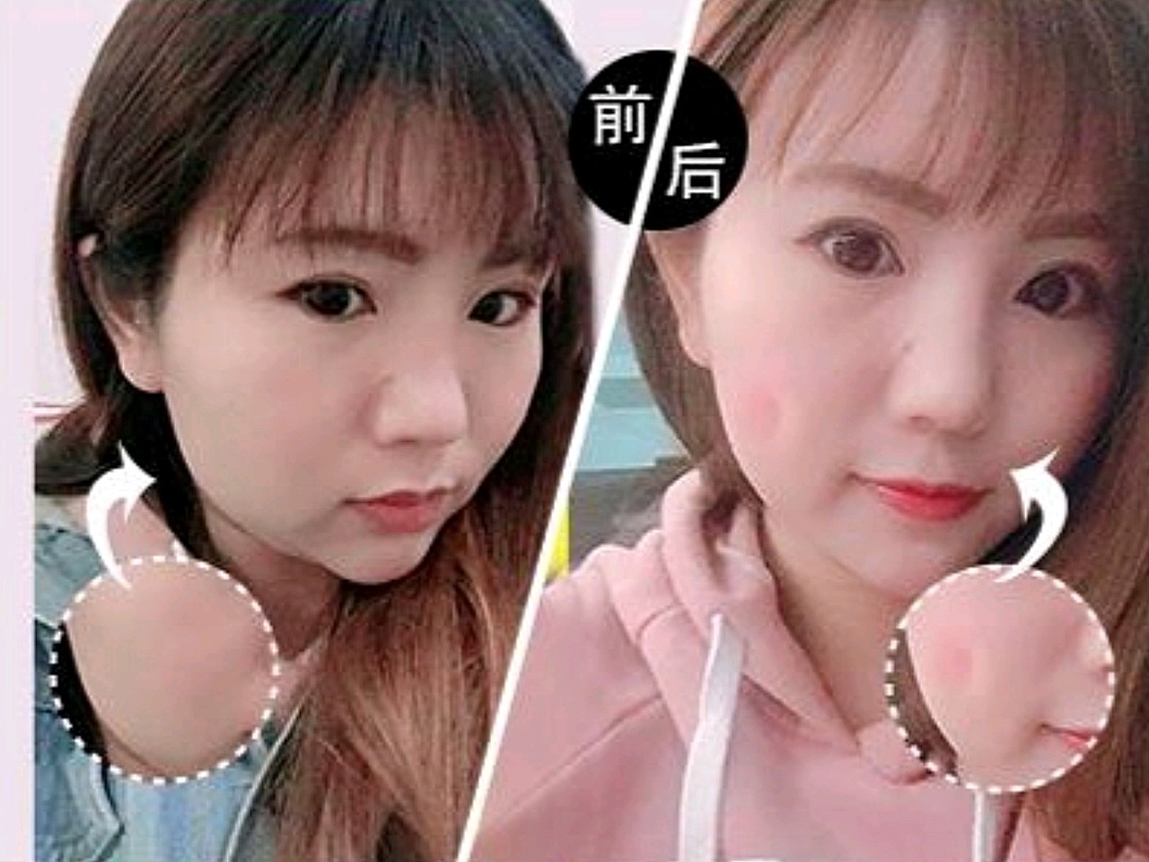 手术过程: 酒窝成形术是在特定的部位,_圈子-新氧美容整形