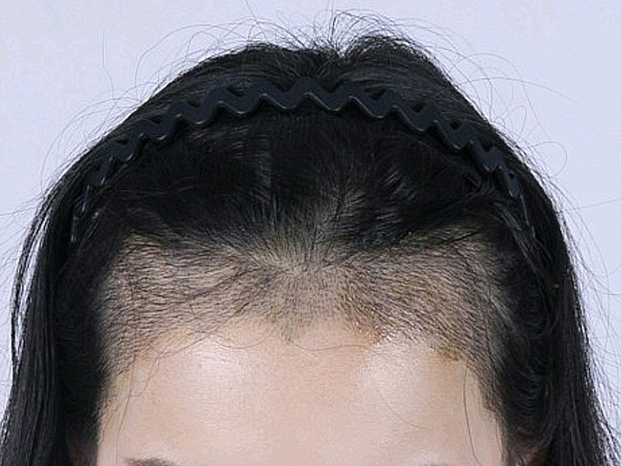 洗过头,现在发际线种植区是干干净净的,两侧的头发要_圈子-新氧美容