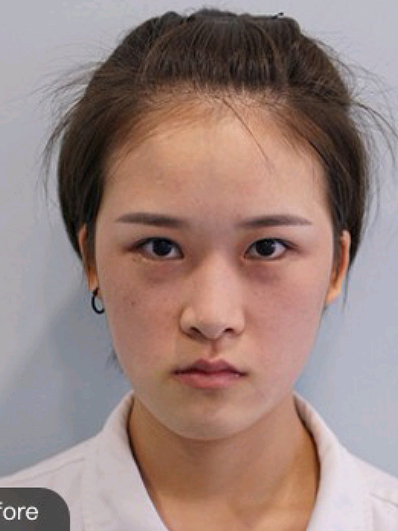 做面部轮廓精致套餐已经有几个月了,脸部明显比之前白_圈子-新氧美容