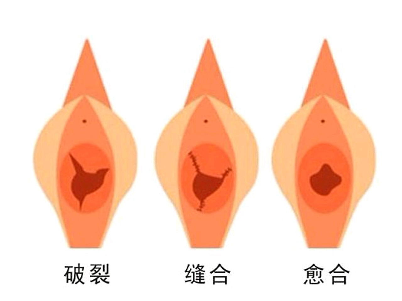 处女膜修复有没有副作用?处女膜修复手术没有什么副作_圈子-新氧美容