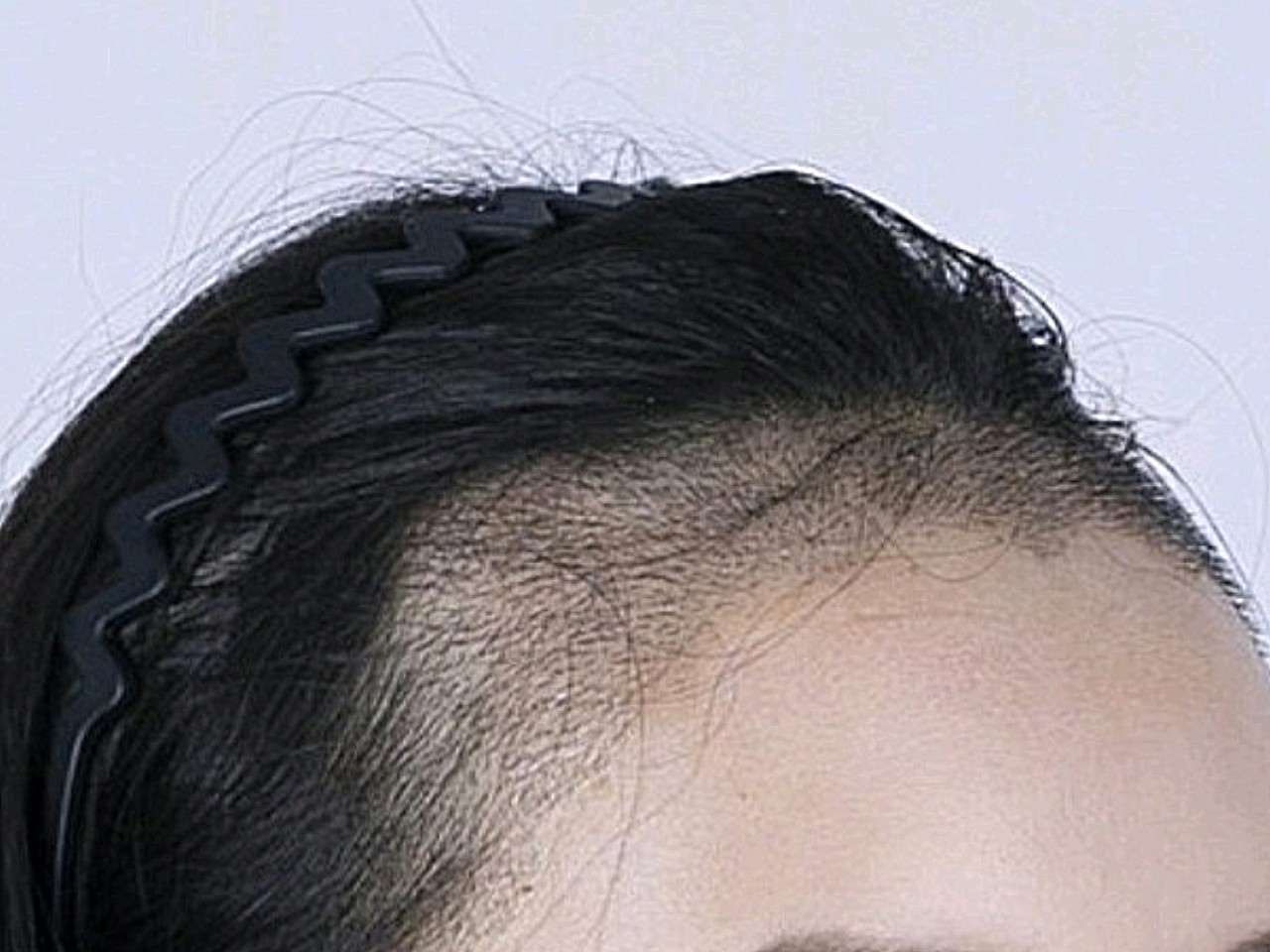 洗过头,现在发际线种植区是干干净净的,两侧的头发要_圈子-新氧美容