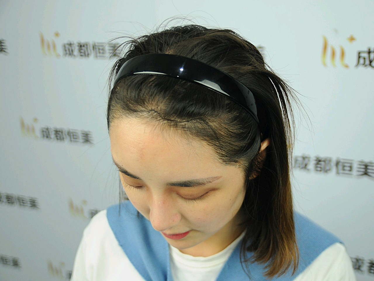 额角天生就有点缺,空了一块出来,发际线我用手一比都超过五根手指了