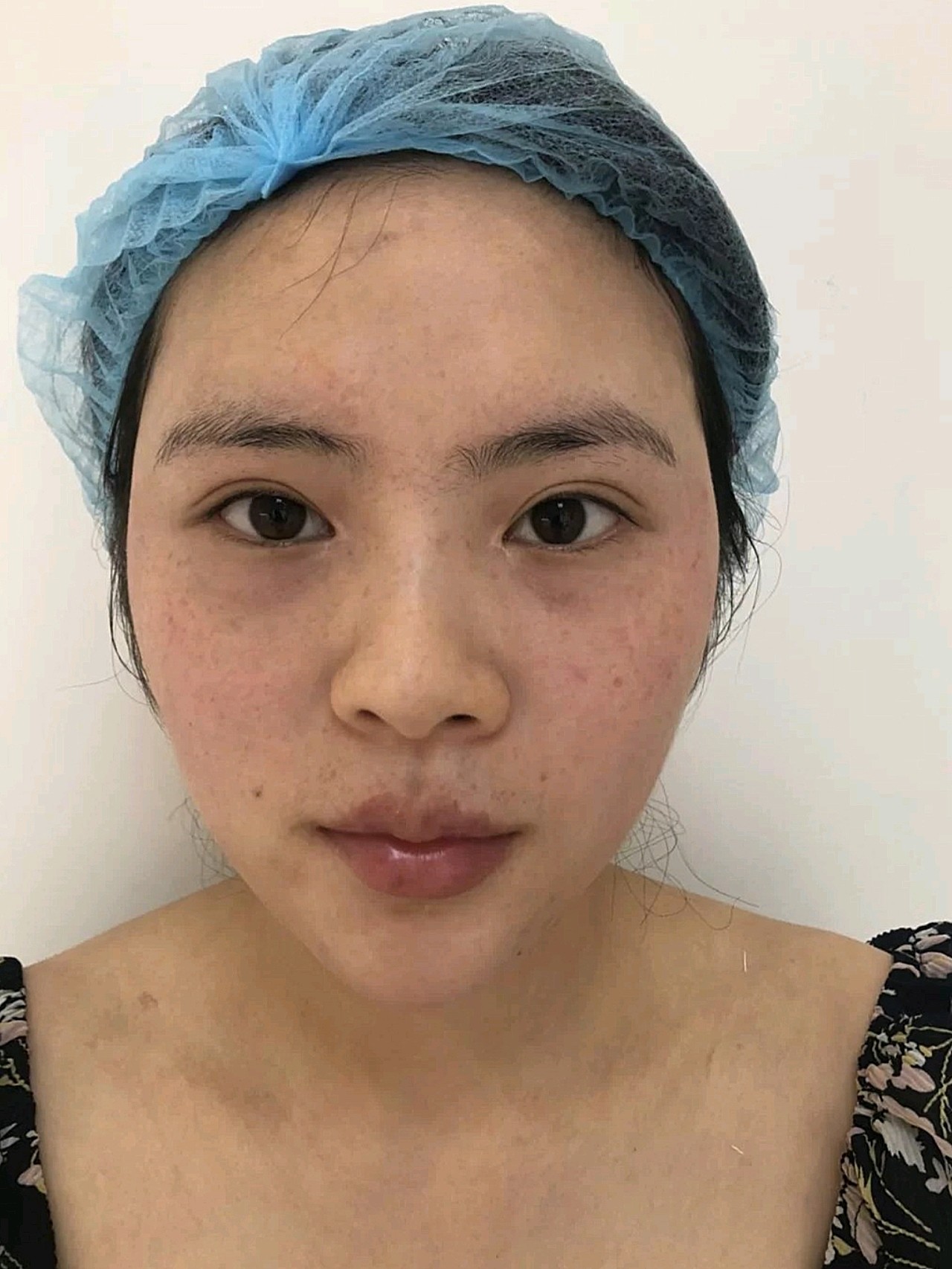 面部的填充让脸部饱满起来了,时间真快,但是时间现在带不走我的美貌了