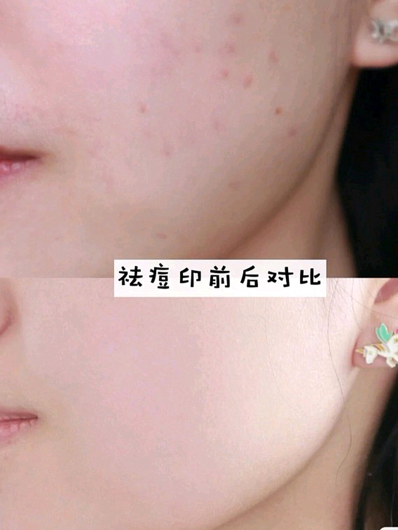 光子嫩肤可以祛痘印吗?