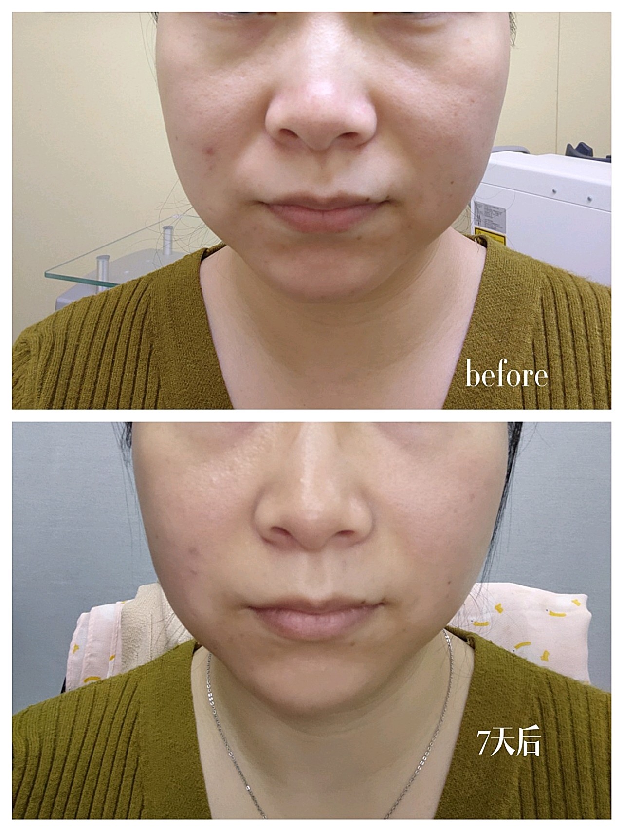 新氧试用官fotona