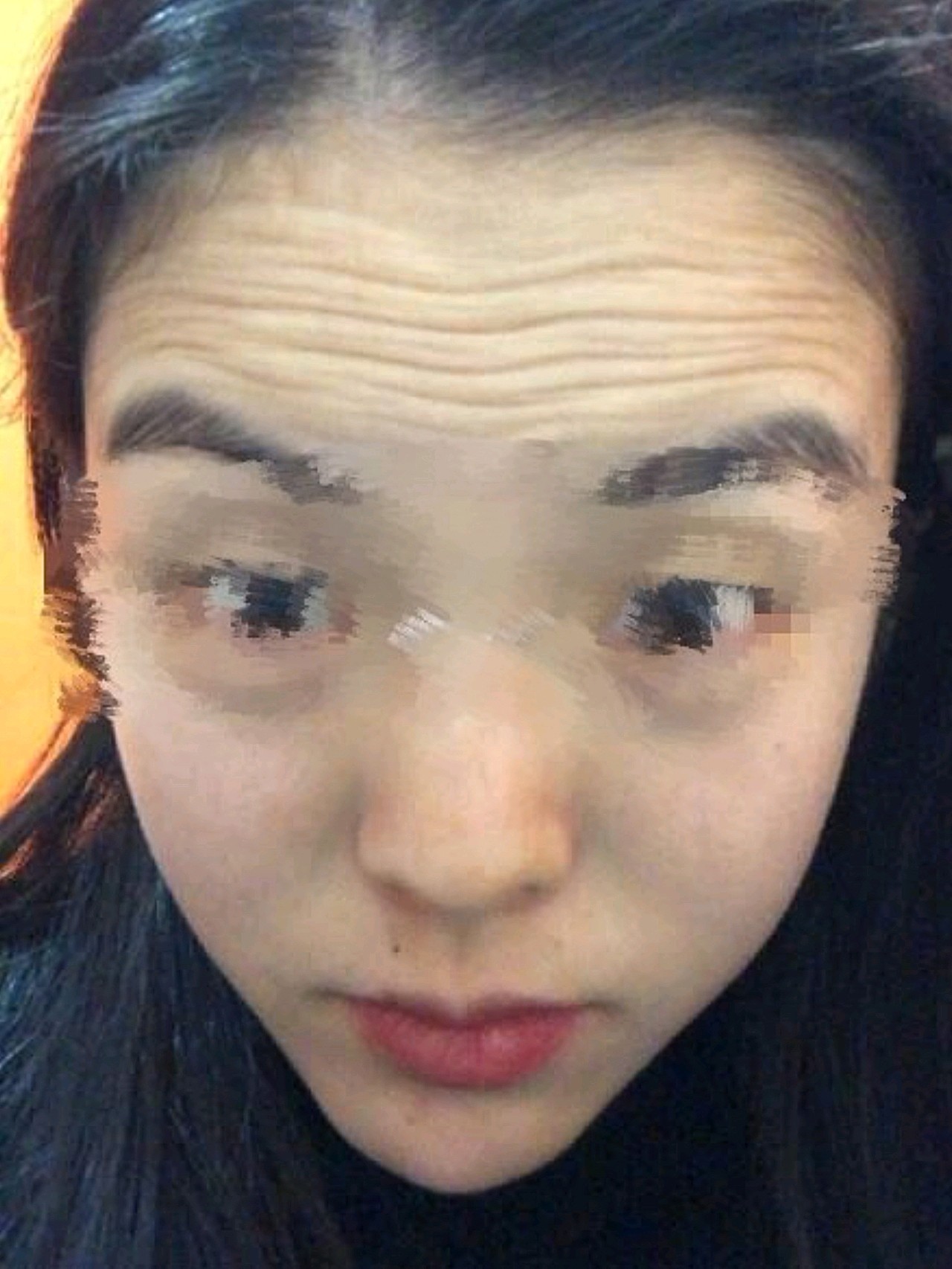 我抬头纹蛮严重的,打了眉间纹和抬头纹两个部位,打完之后用力抬眉也不