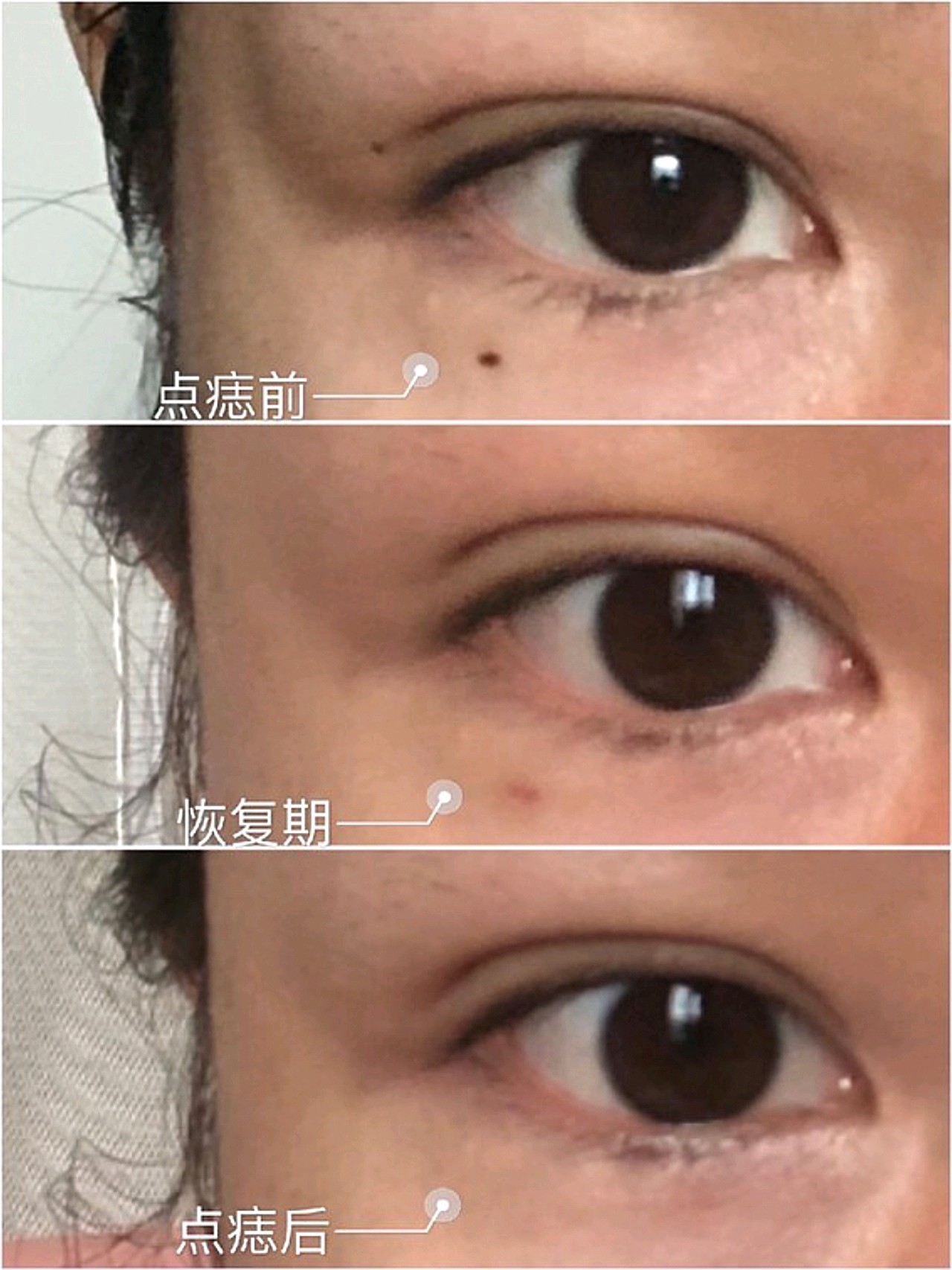 如何安全去痣