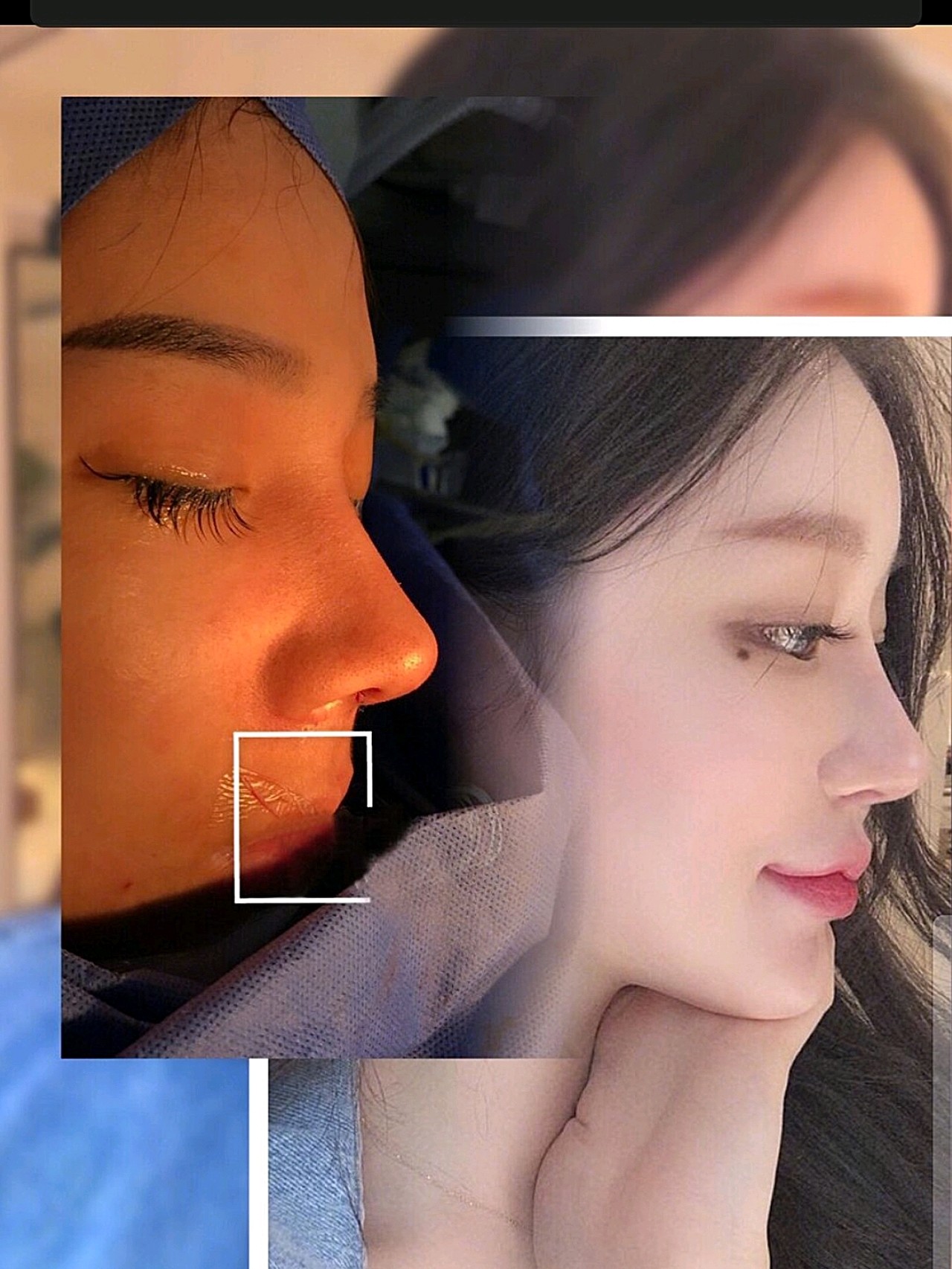 网红主播小小同款鼻_圈子-新氧美容整形