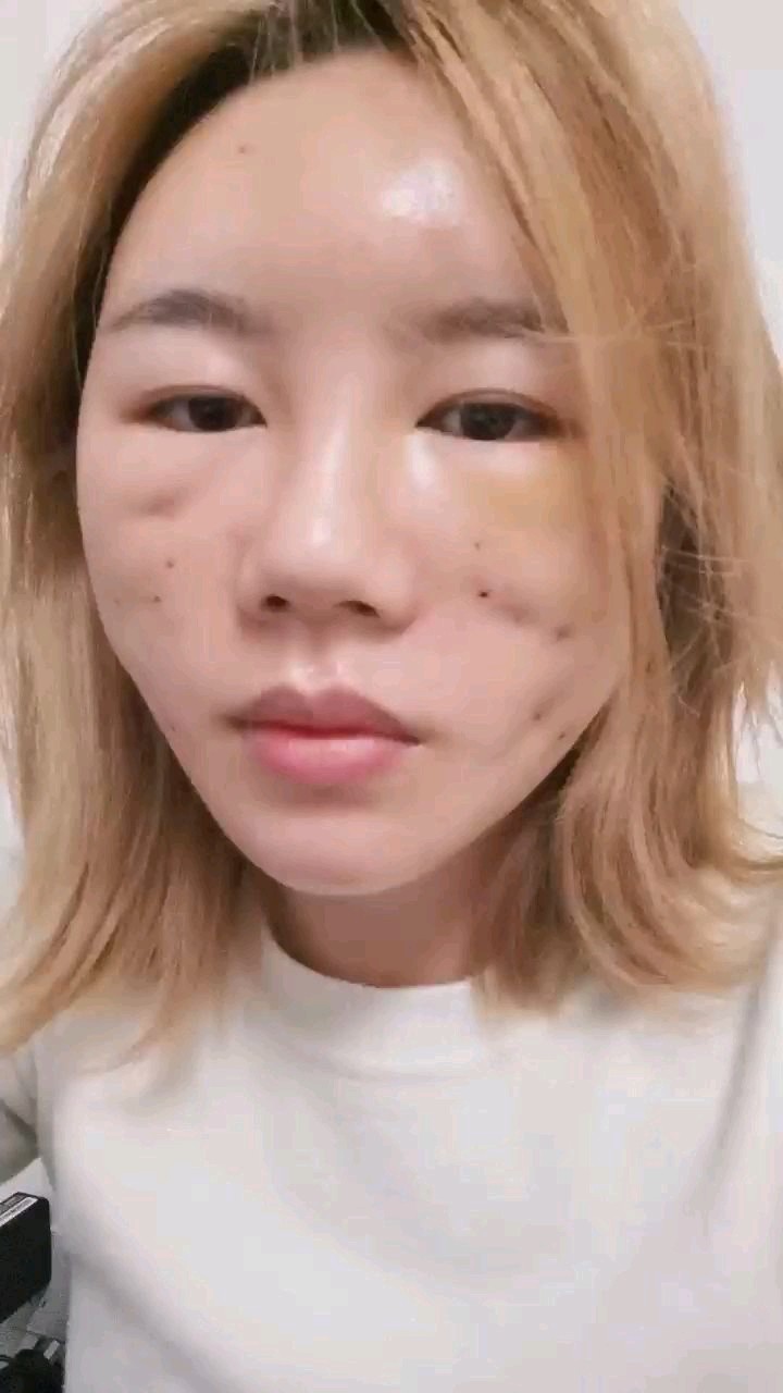 新氧体验馆34期秘特线雕第五天,还是很肿,水肿体质_圈子-新氧美容整形