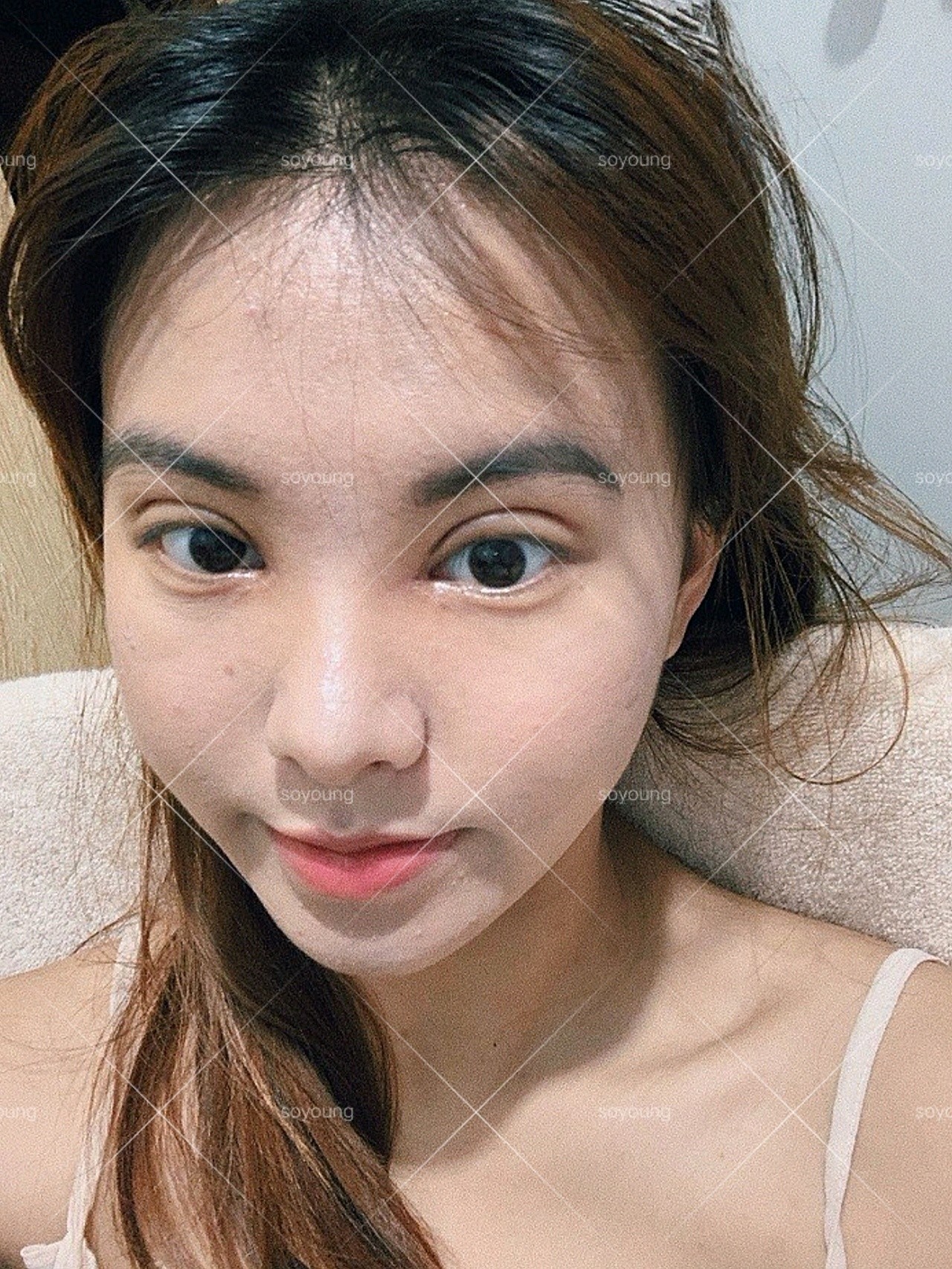 双眼皮案例分享 | 一双眼真的能拯救一张脸吗?