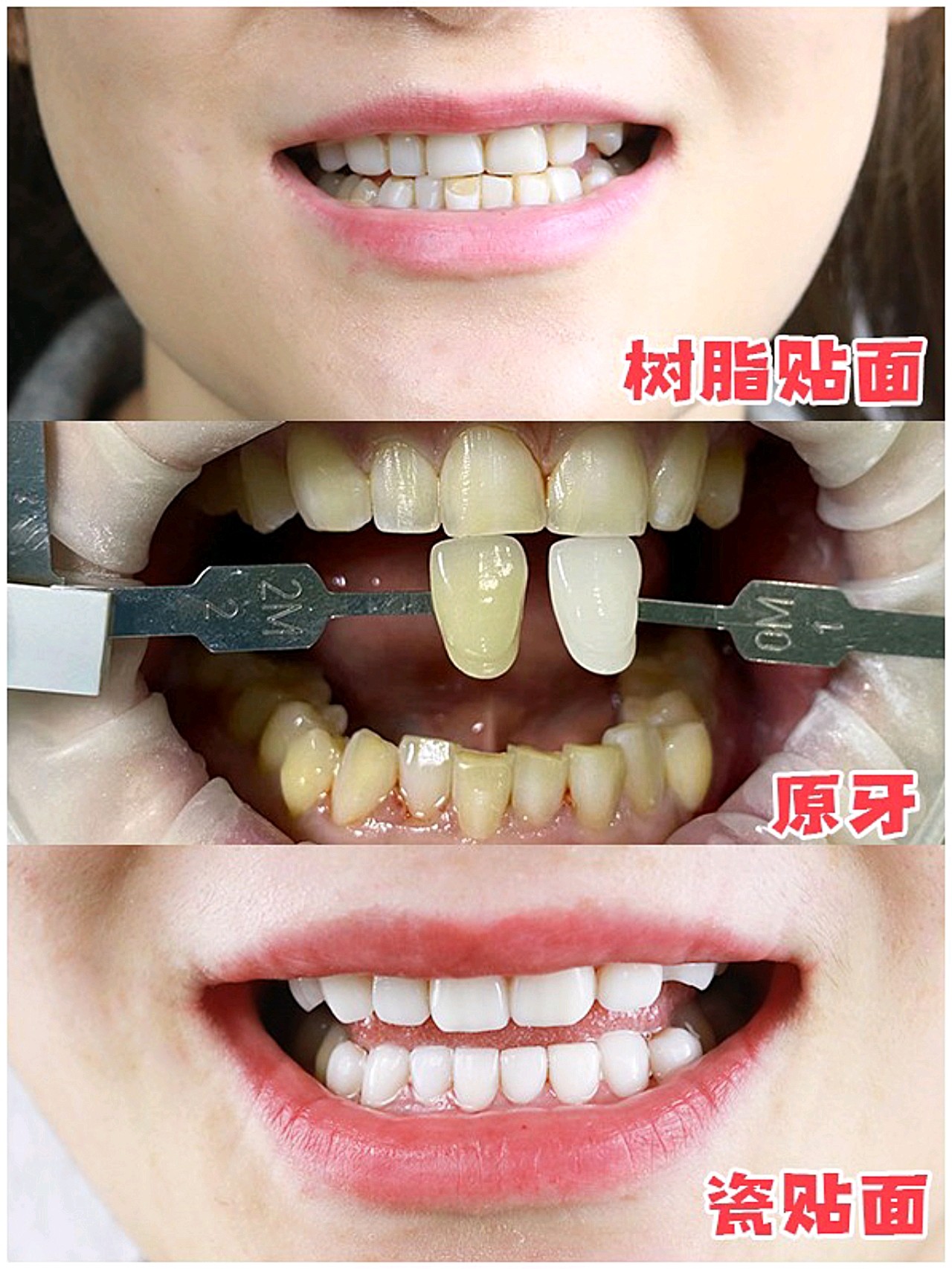 今日分享一位,树脂牙换全瓷贴面的案例