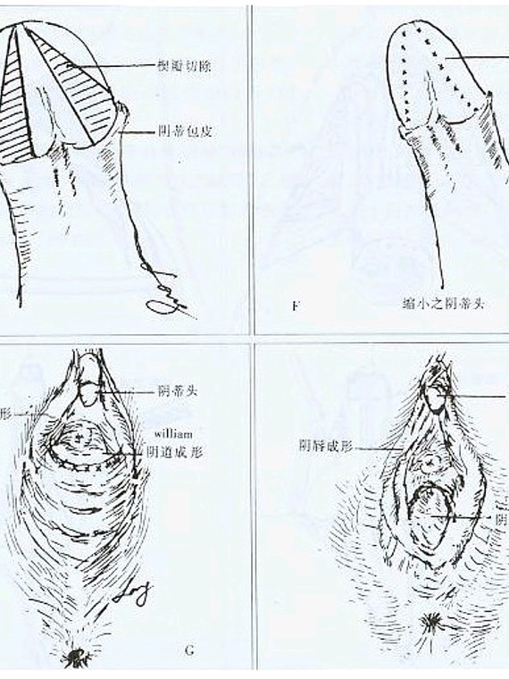 女性荫蒂实物图图片