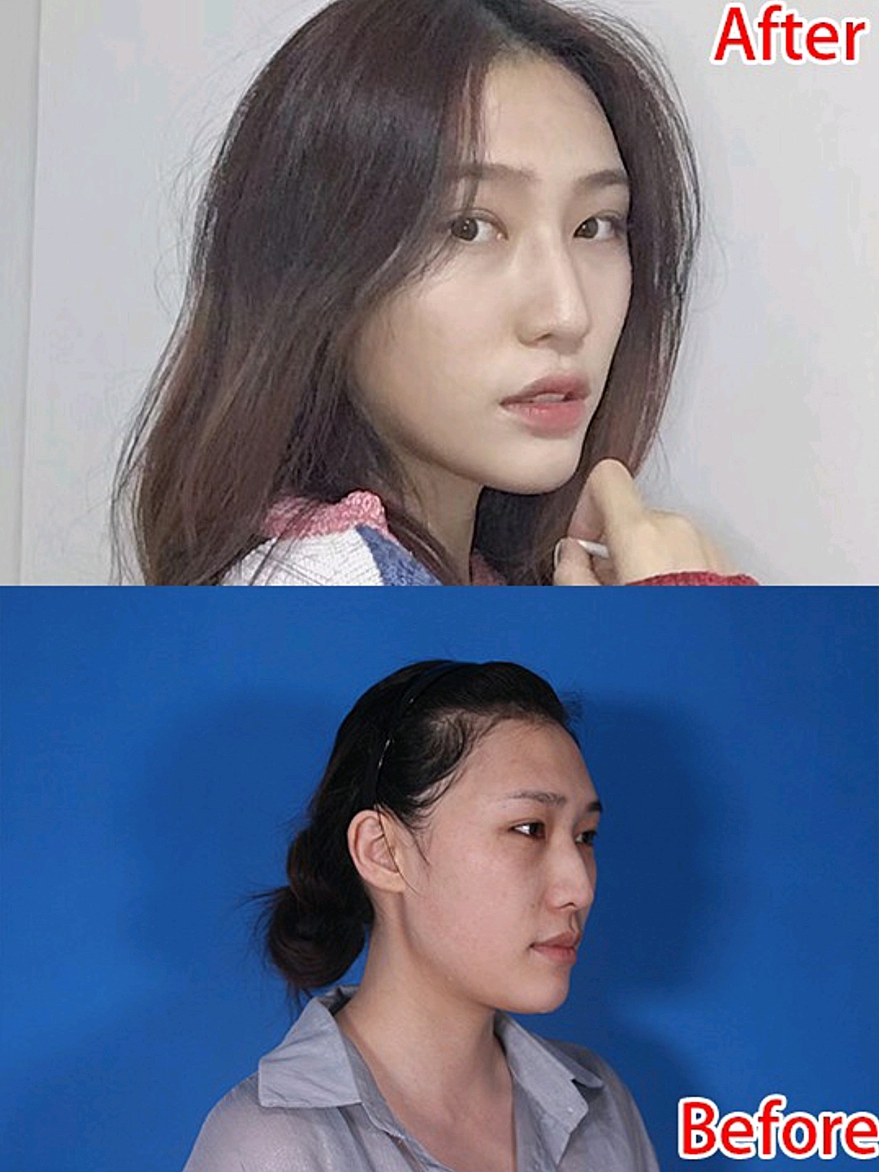 驼峰鼻从正面看偏