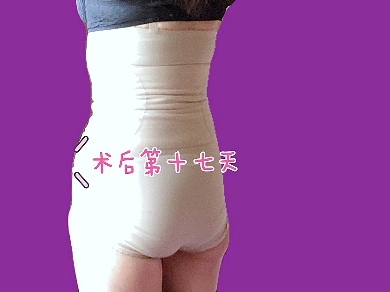 99术后第十七天9999再次告诉大家一下,我是做了腹壁整_圈子