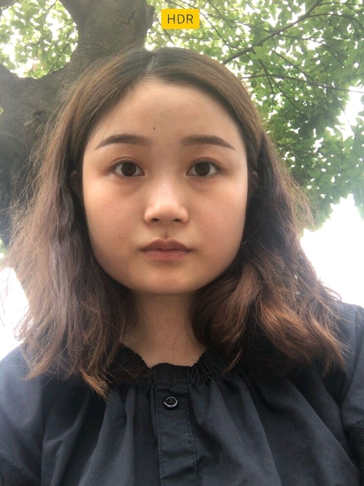 【术前诊断】:下颌角每个人都有,主要是决定下半脸的_圈子-新氧美容