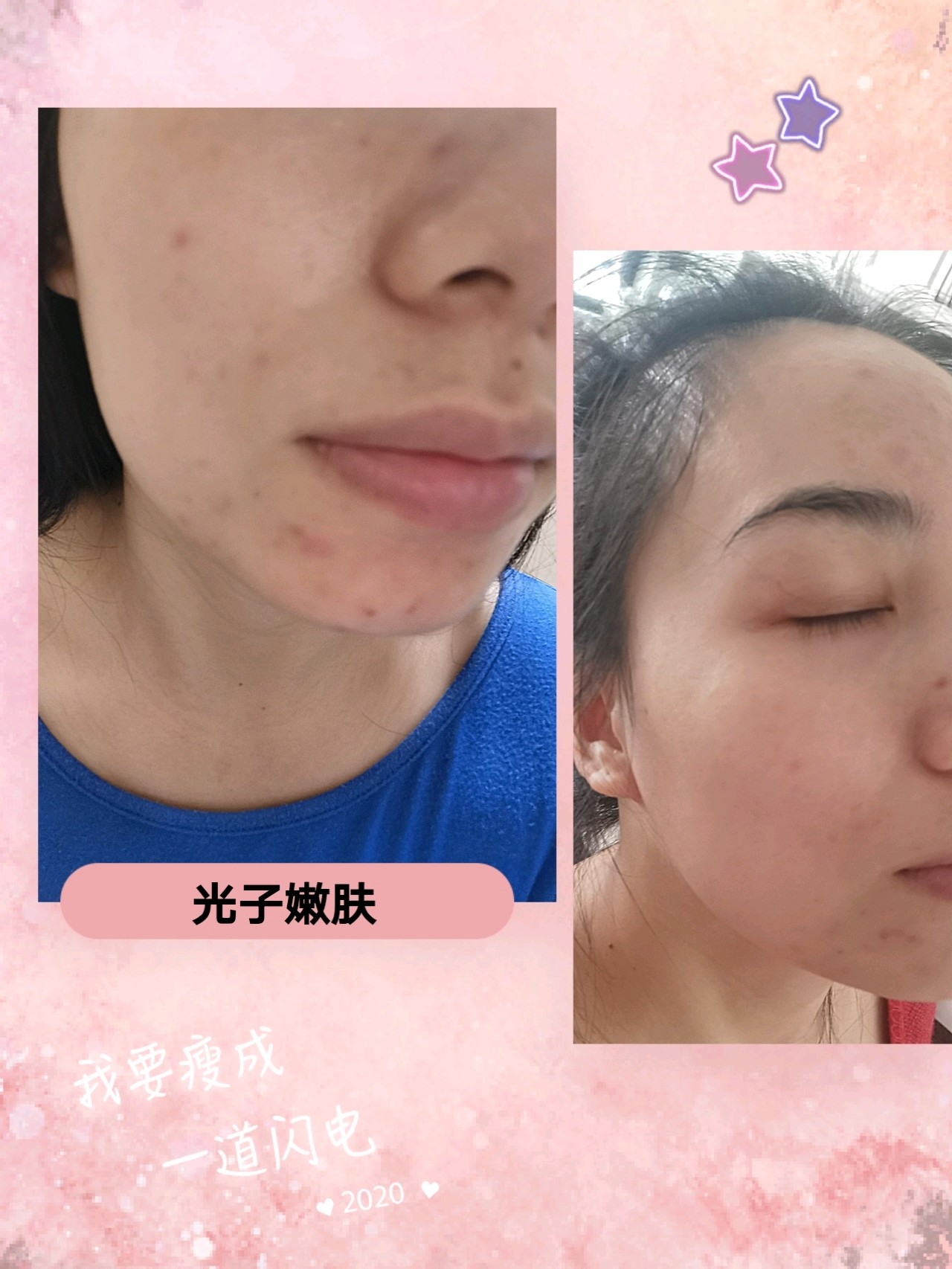 铛铛铛光子嫩肤7天后