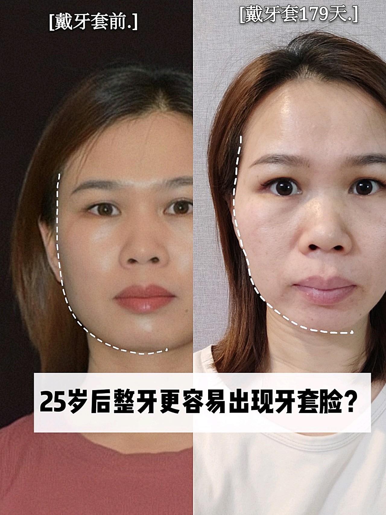 25岁后整牙更容易出现牙套脸?