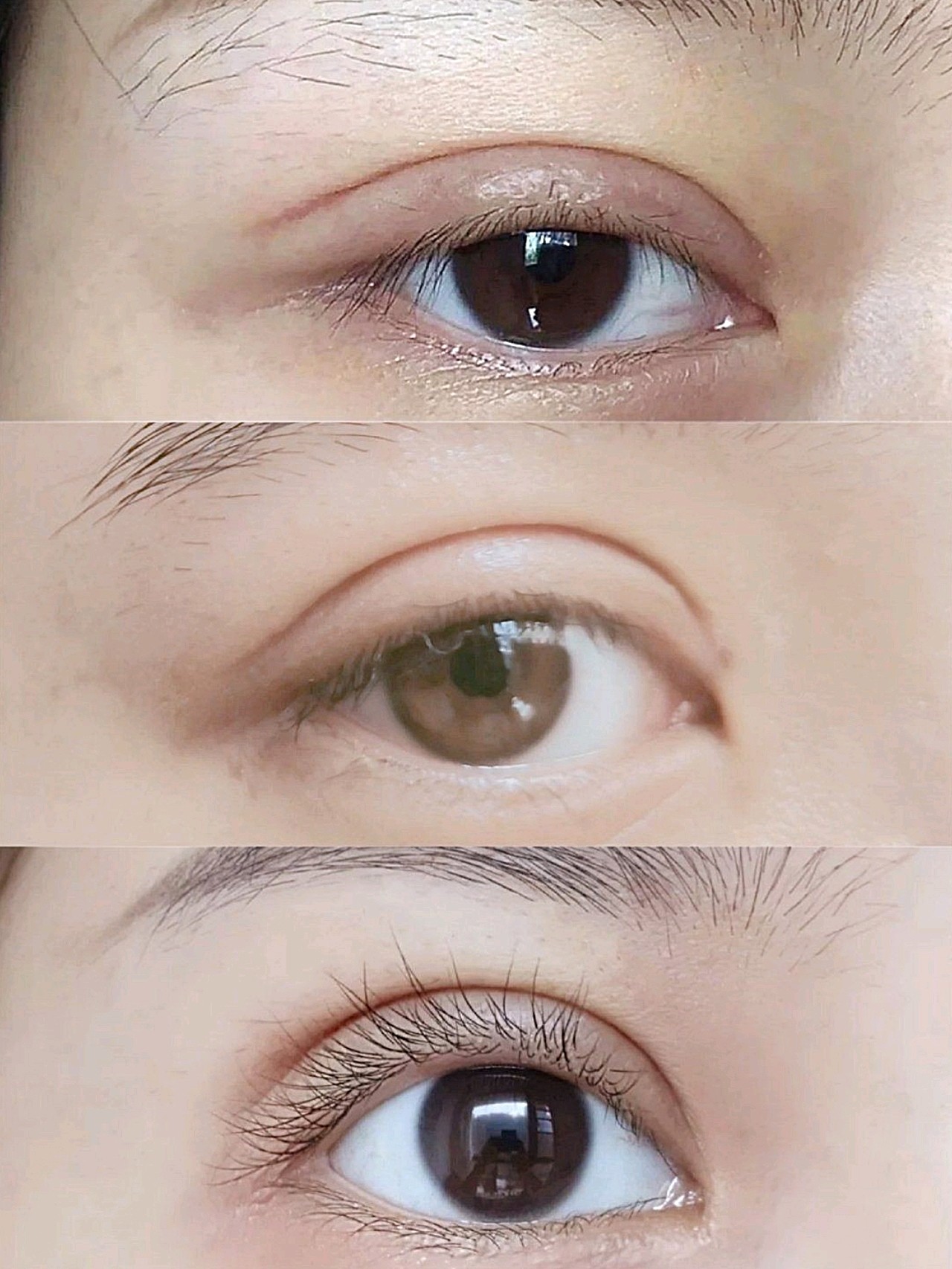5mm,现在闭眼无痕,双眼皮宽度形状都很自然,完全看不出来是割的 分享