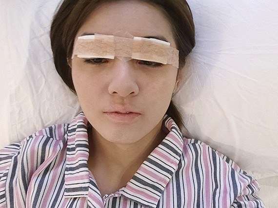 现在眼睛上蒙着纱布,看不到什么效果,过几天就可以知_圈子-新氧美容