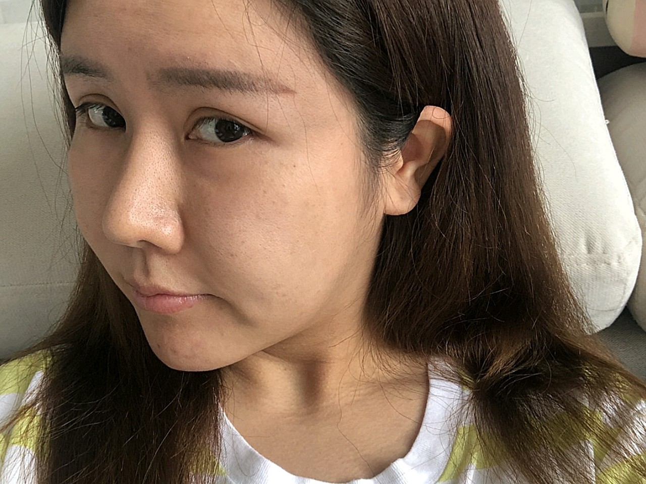 最真实的面部状态,恢复的很天然!比之前更饱满了!_圈子-新氧美容整形