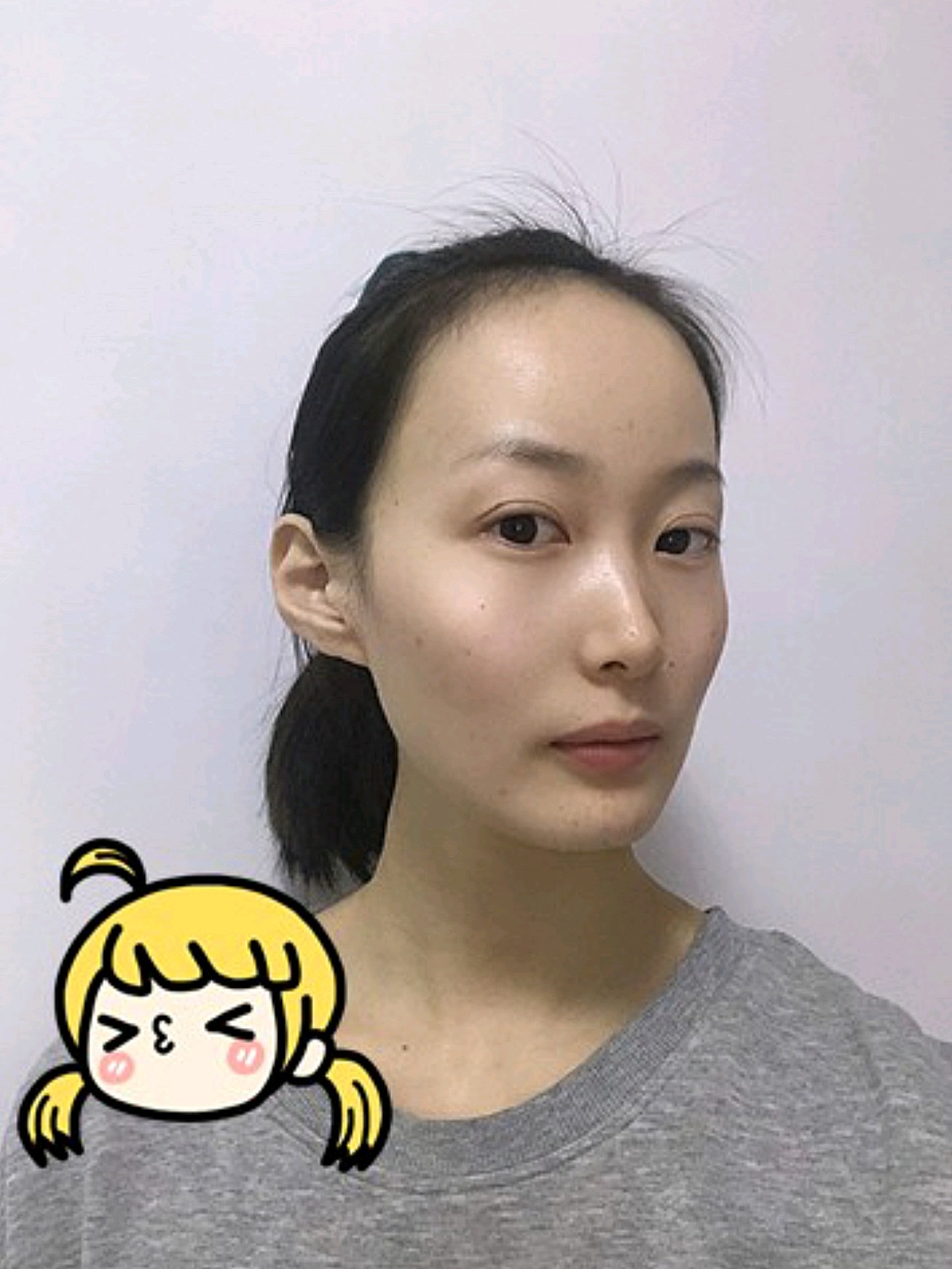 植发前天生大额头是什么感觉,经过我的深思熟虑,终于_圈子-新氧美容