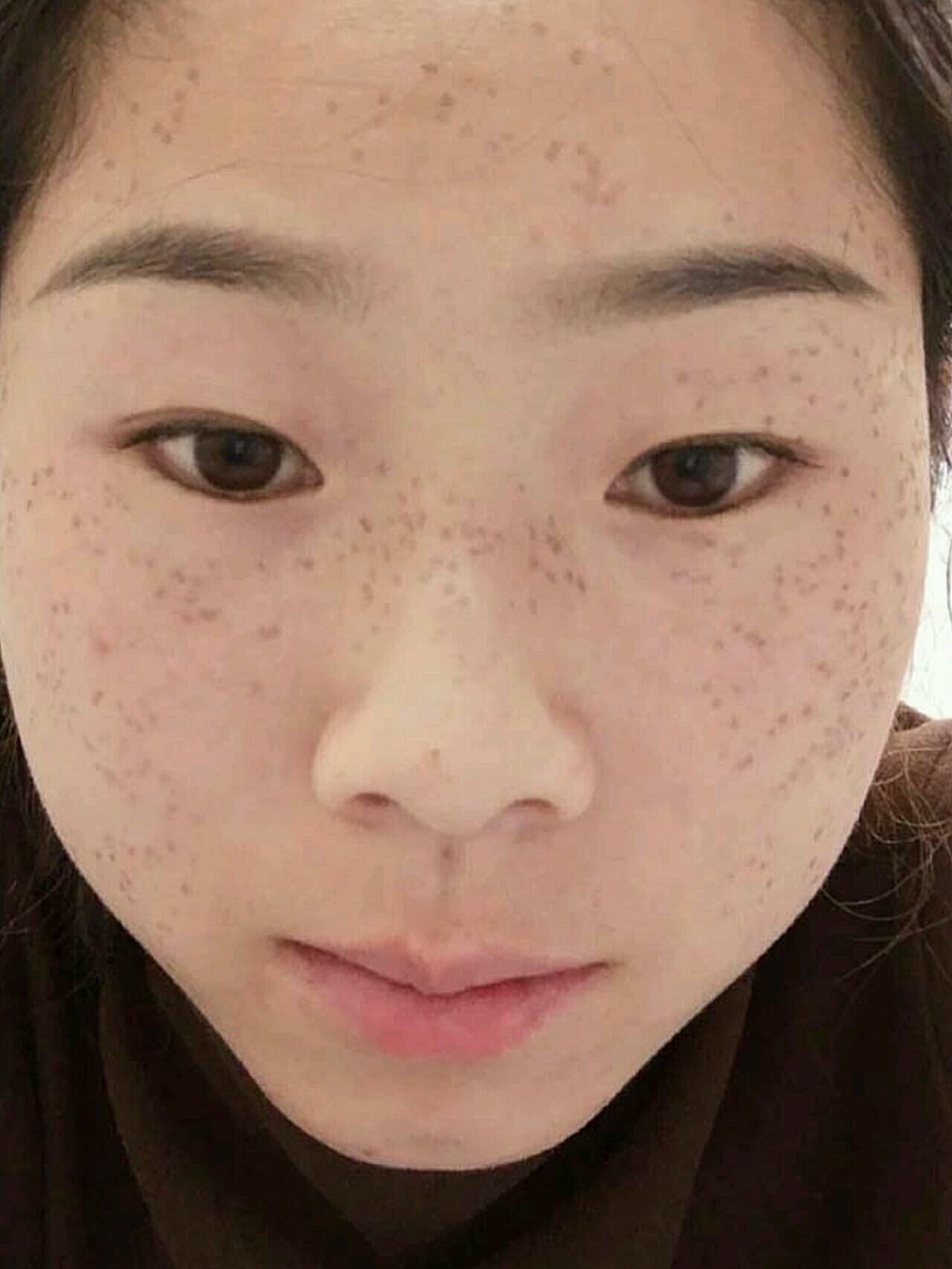 给大家带来最真实的祛斑体验我是遗传性雀斑,斑点跟了_圈子-新氧美容