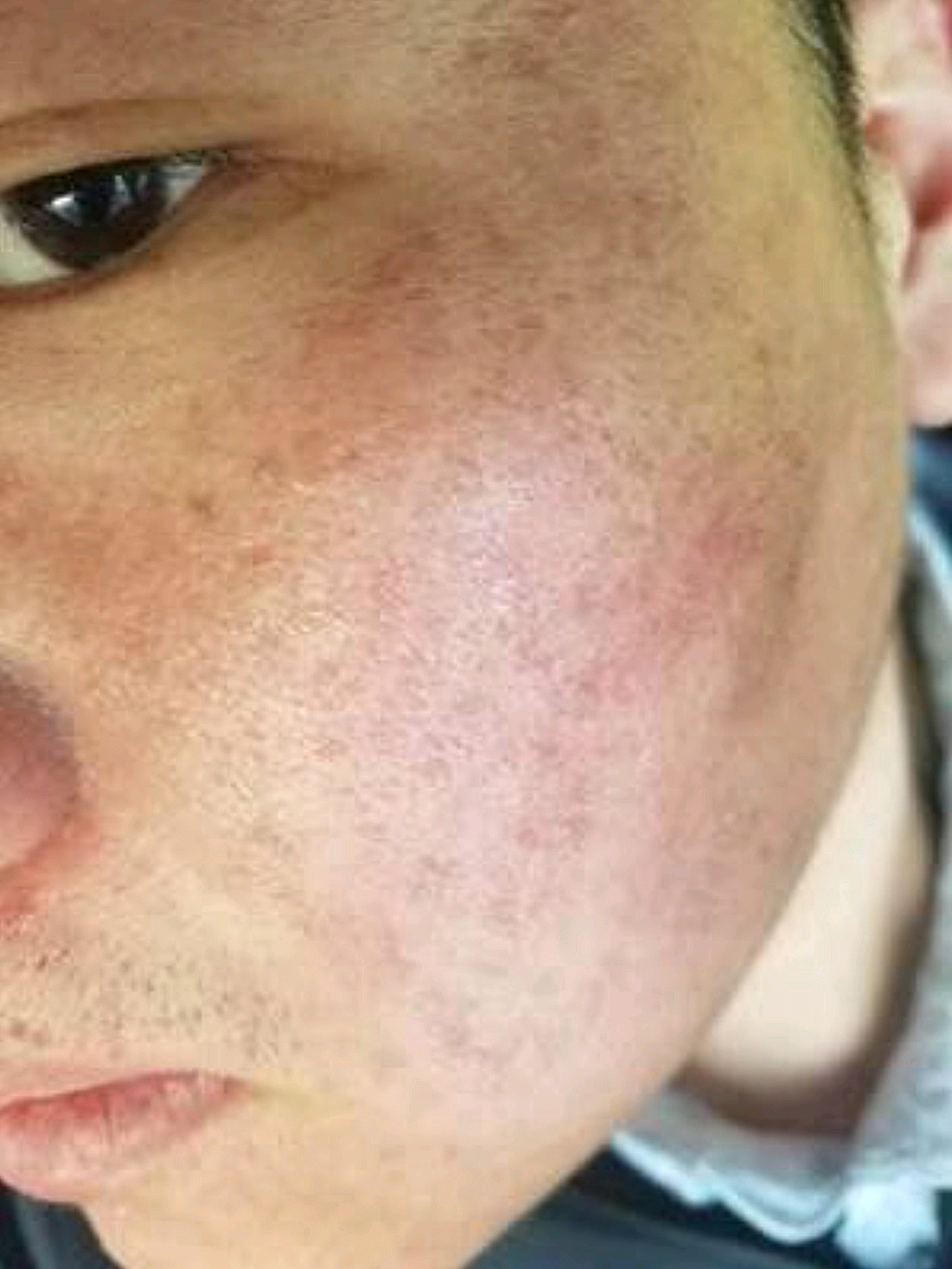 男孩子也要注重美貌!脸上的坑坑洼洼d(д)真的太难看了!