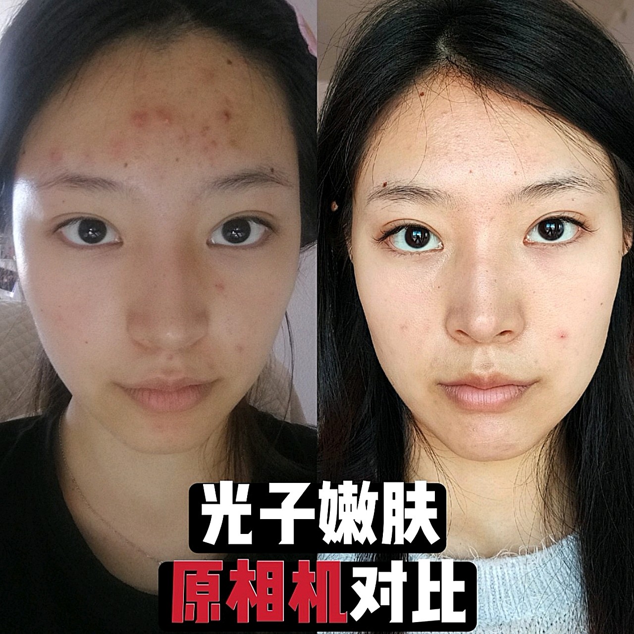 从10月份开始,一共做了2次光子嫩肤了,效果比我想象中的好很多,放无p