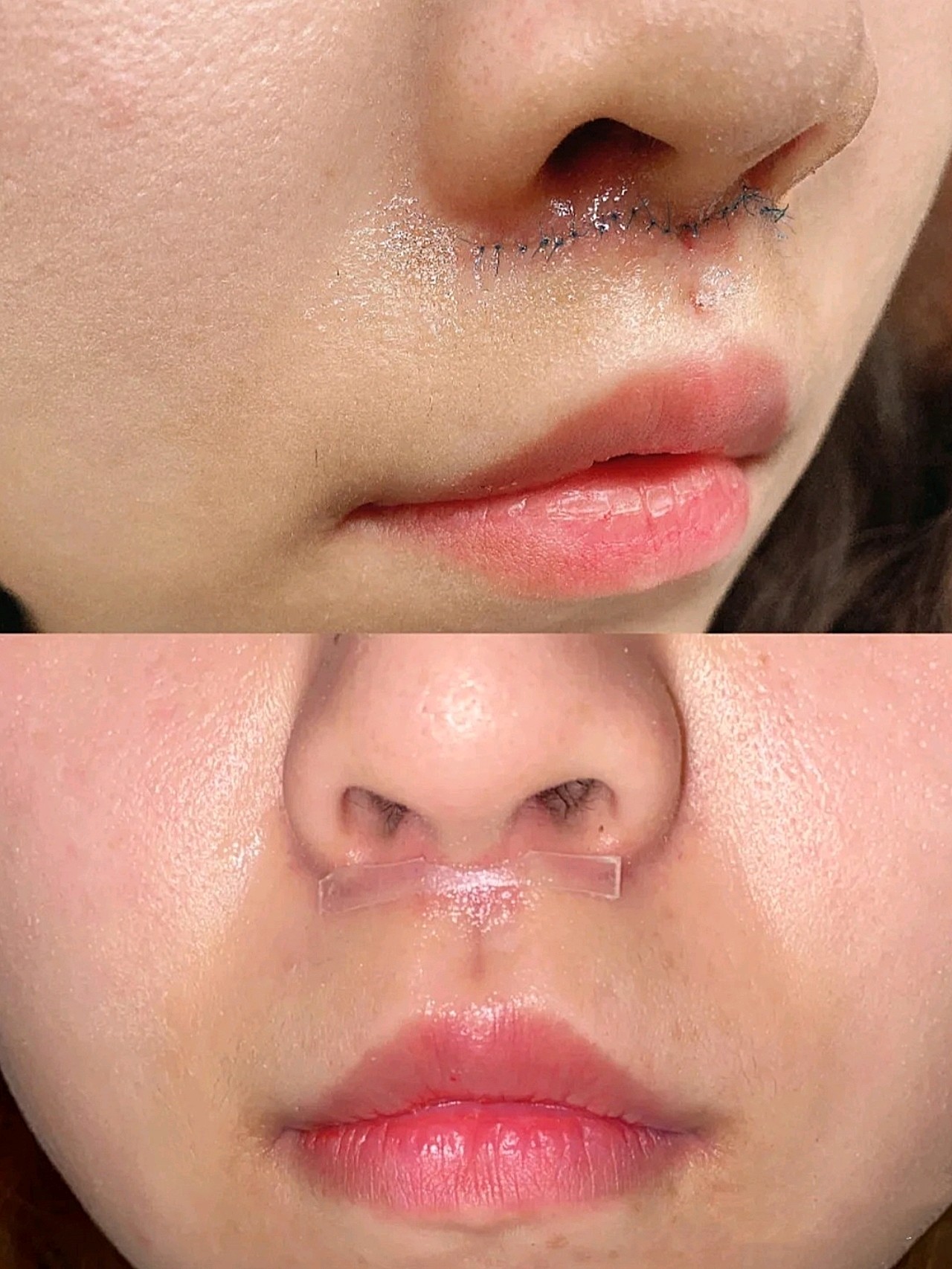 缩短跟人中加深一起做的,效果很好,立马就年轻了_圈子-新氧美容整形